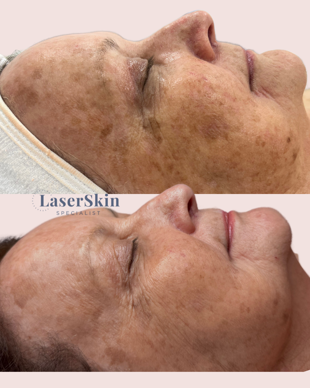 PIGMENTATION | Before & After 6 X Facial Peel Treatments