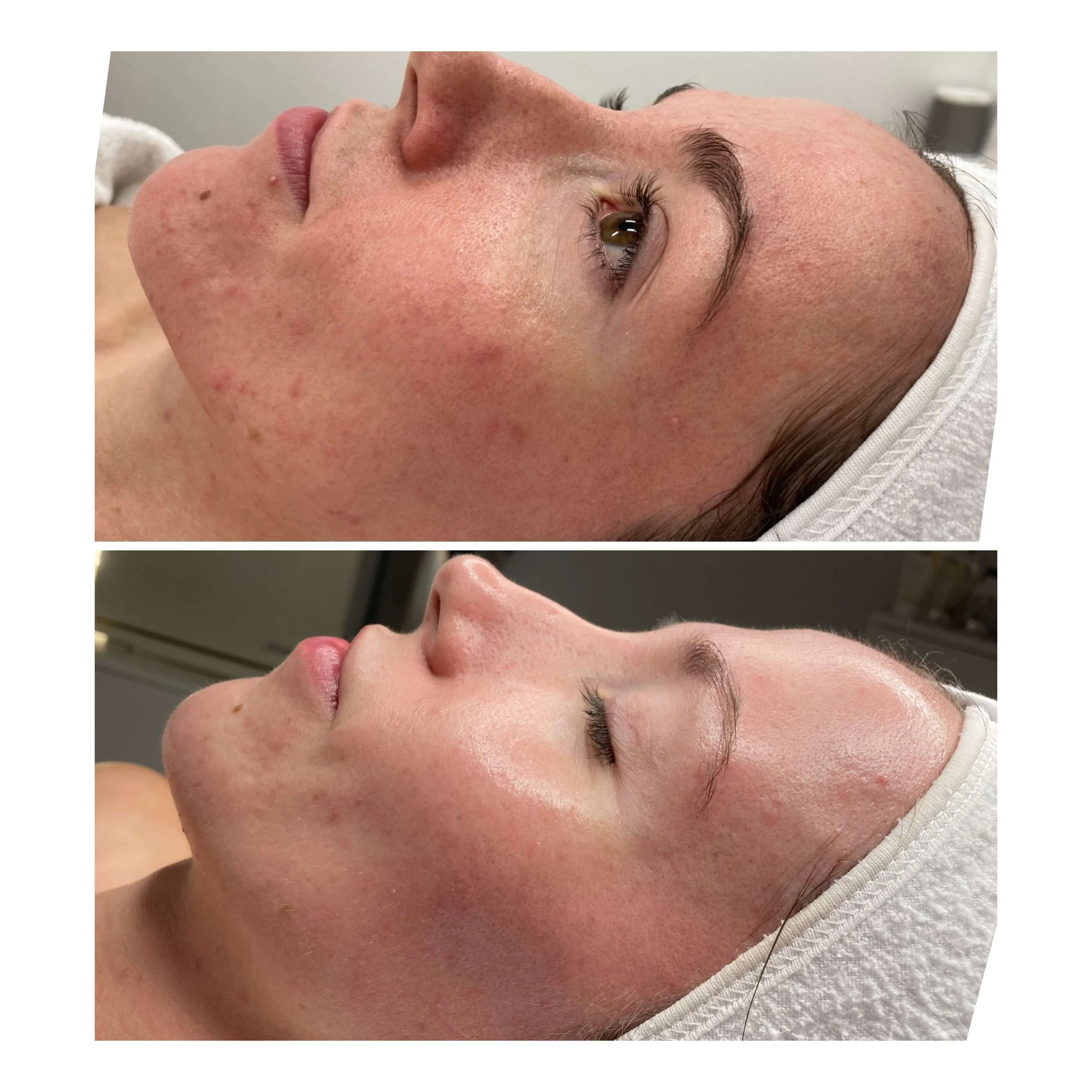 Facial and peel before and after result for redness and congestion