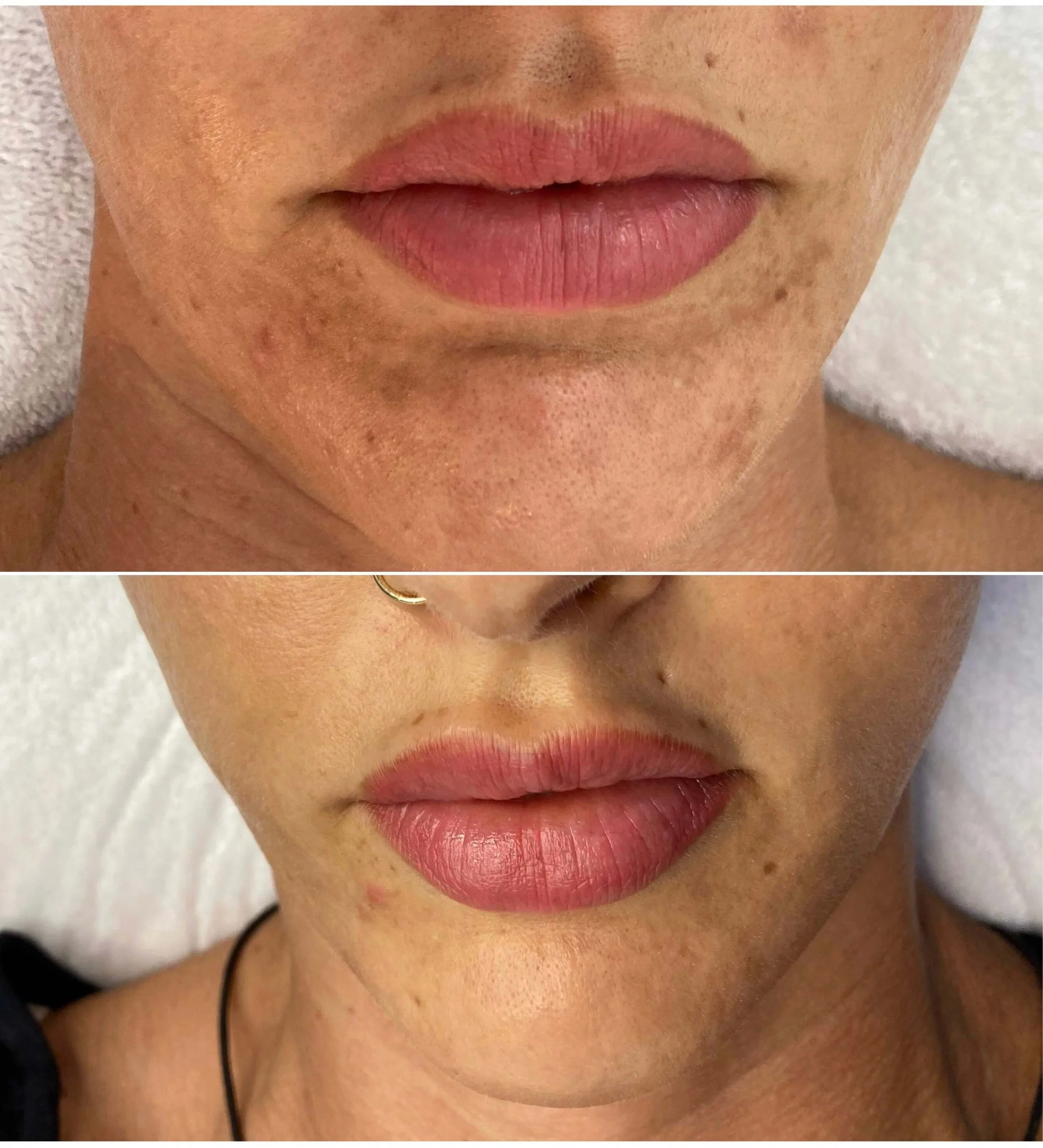 Skin resurfacing pigmentation result before and after