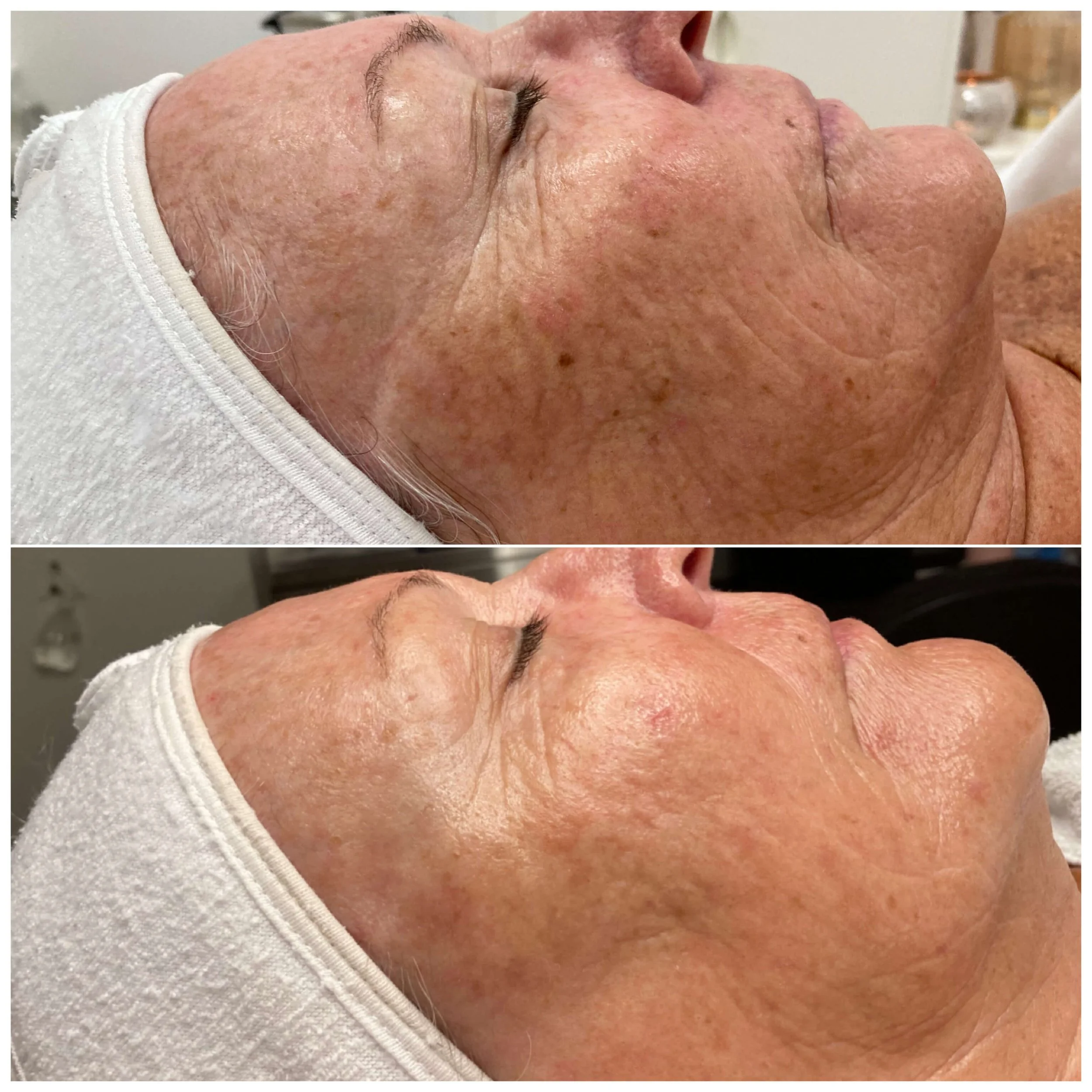 BBL pigmentation result before and after