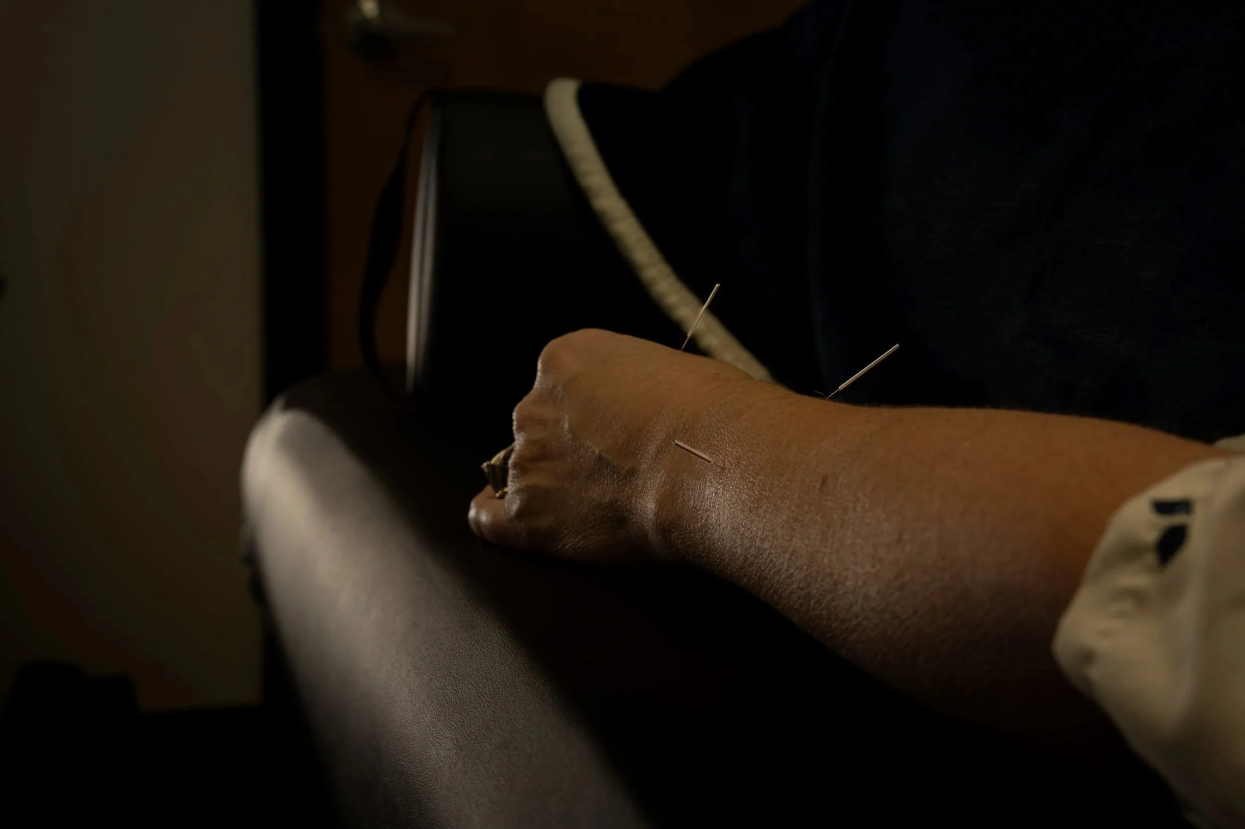 Dry Needling: Clinical Overview and Relationship to Acupuncture