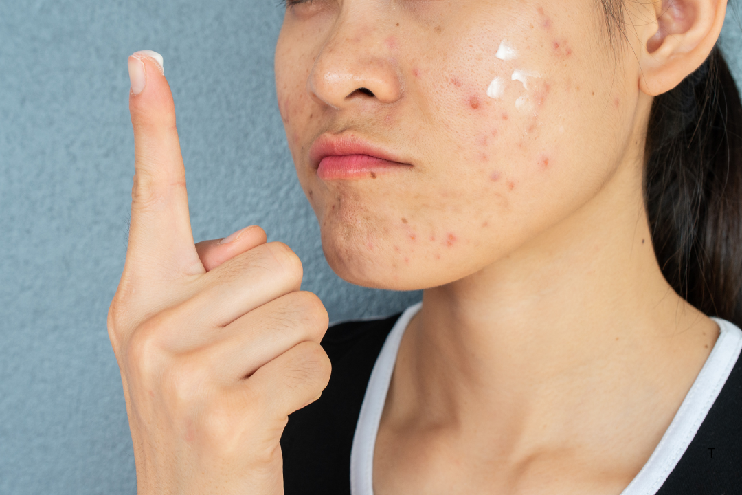 Can What You Eat Affect Your Skin?