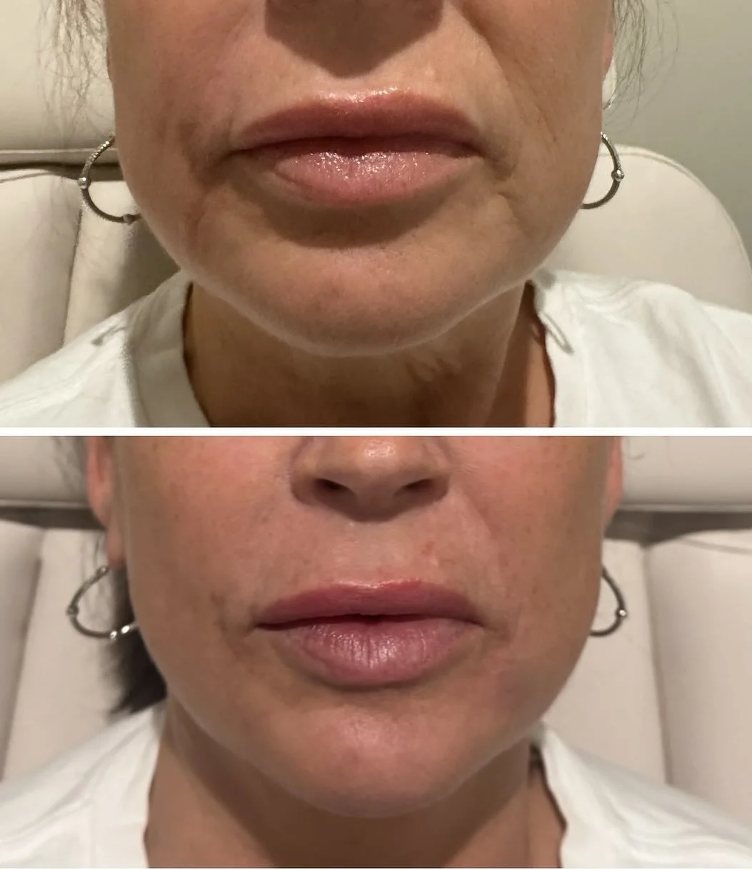 Proof that a little filler goes a long way 😍 One total syringe was used between her Nasolabial Folds, Marionette Lines, &amp; Upper Lip. 

Injector: @be_you_tiful_injections 

DM, Call/Text, or go online to book! 

#fortworthmedspa #filler #northtex