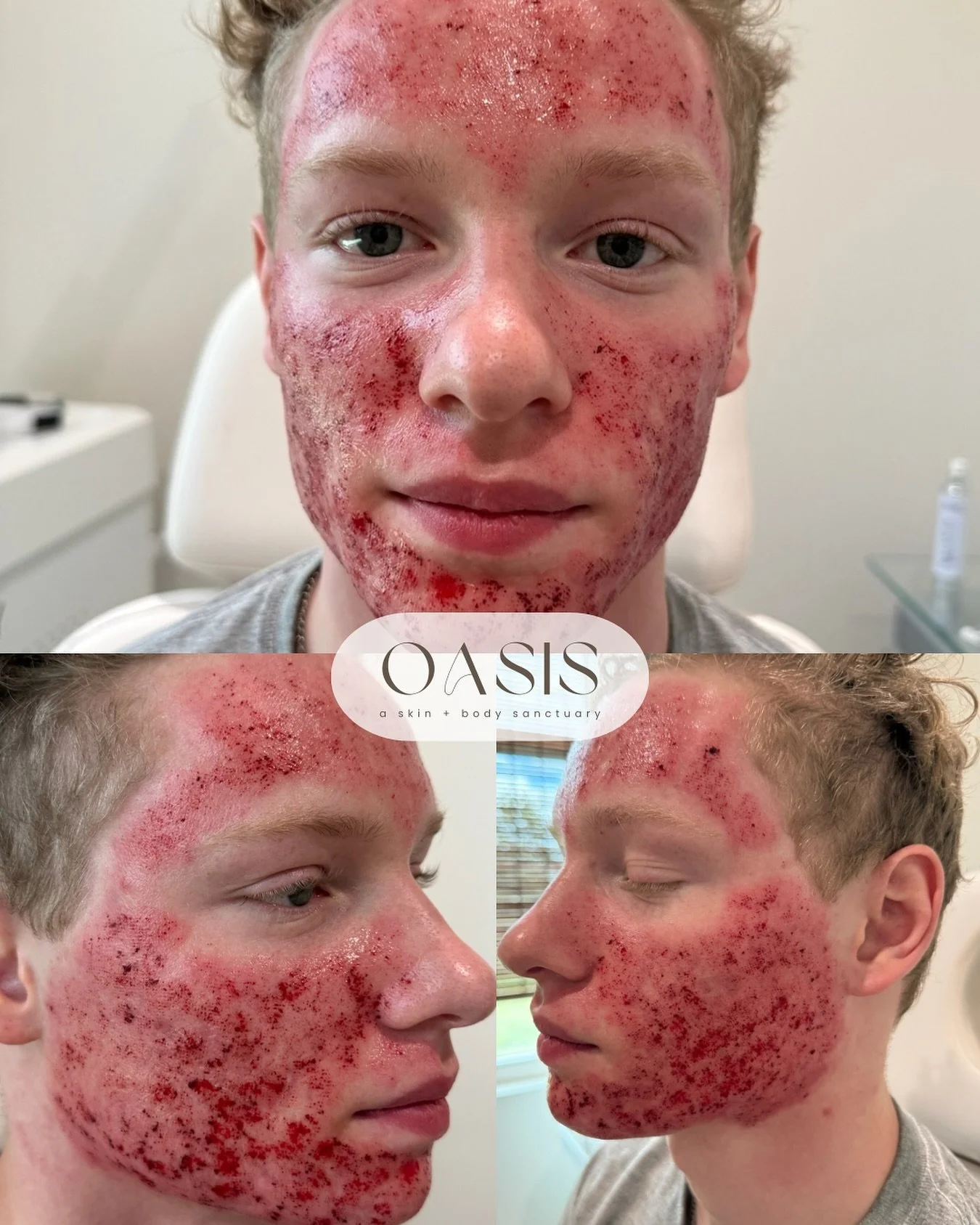 IMMEDIATELY AFTER TREATMENT

Our acne-scarring laser treatment with the Astanza Trinity targets texture and tone at every level.

🪄 We begin with 3&ndash;4 passes using the deep fractionated beam handpiece (1064 q-switched mode) to resurface &amp; s