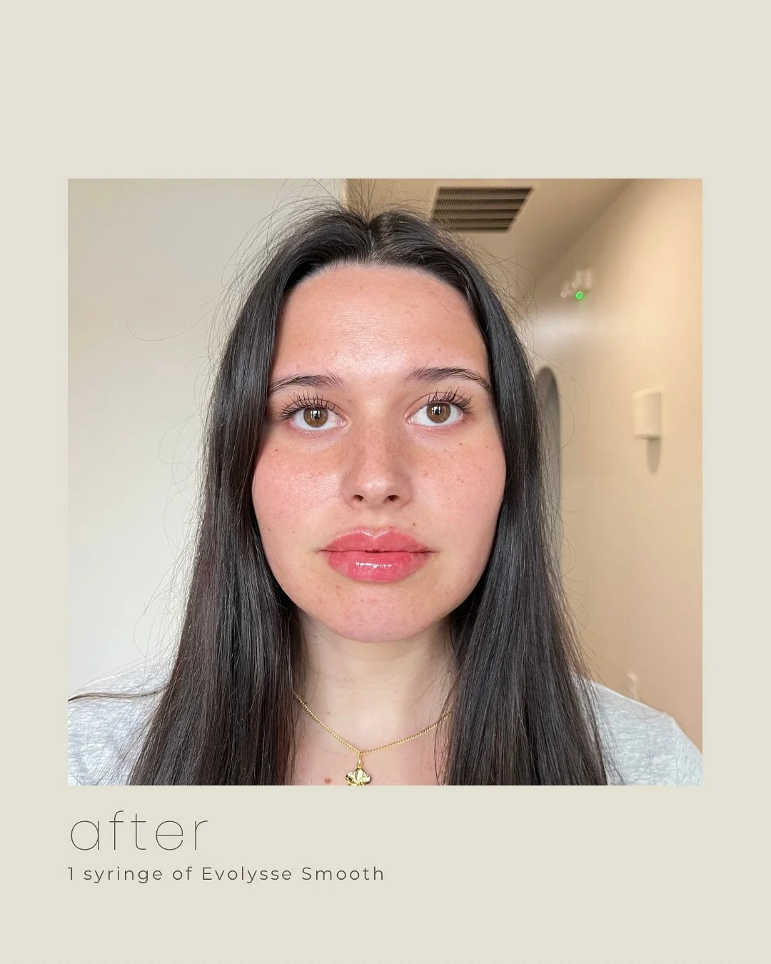 A gorgeous lip transformation by @injectormadsrn 🤍💋

#lipfiller #beforeandafter #fortworthinjector #dfwmedspa #liptransformation #fortworthbeauty