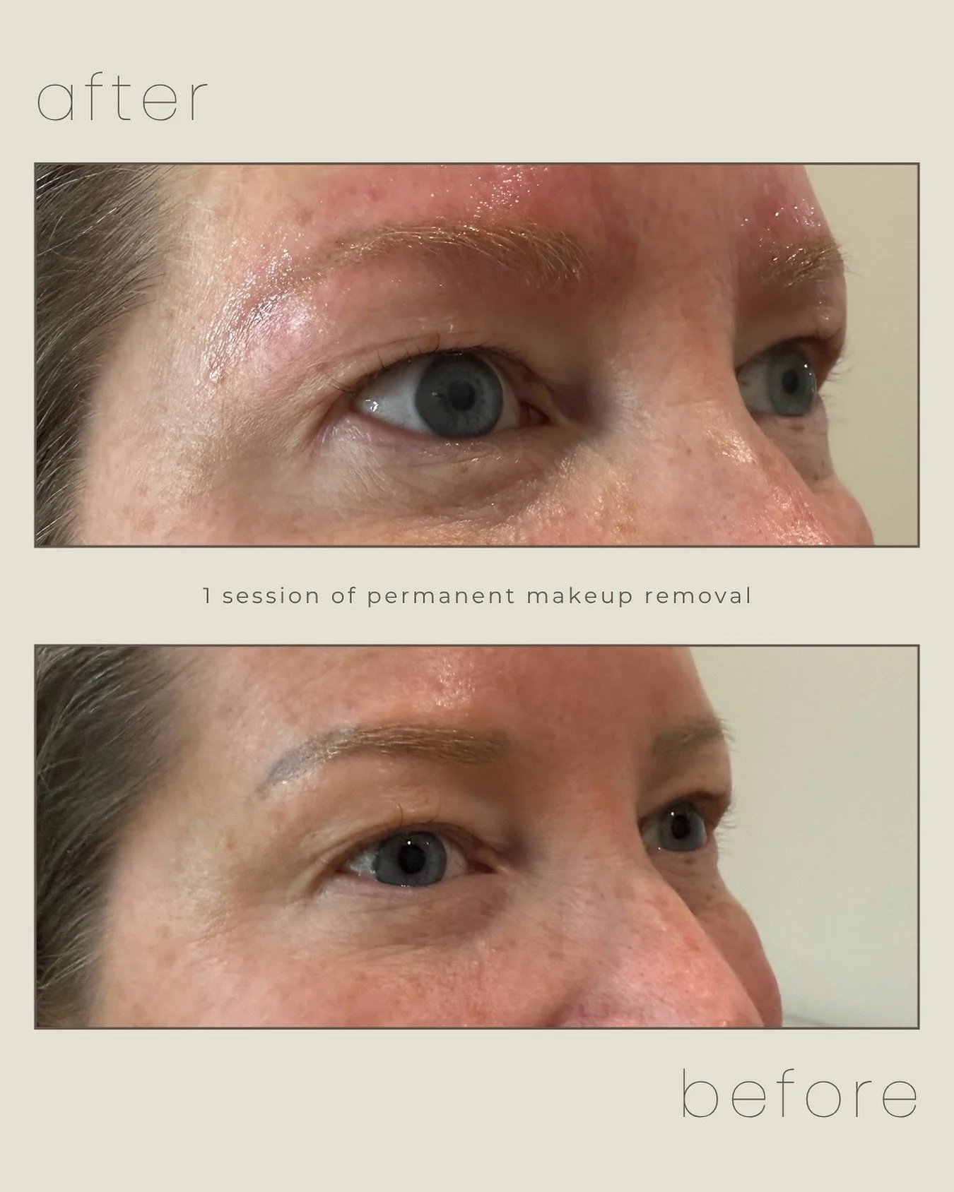 Ready for a fresh start 🤍

After just one session of permanent makeup removal, these brows are already softer and more natural.

If your brows don&rsquo;t feel like you anymore, we can help you reset.

#beforeandafter #permanentmakeupremoval #dfwbea