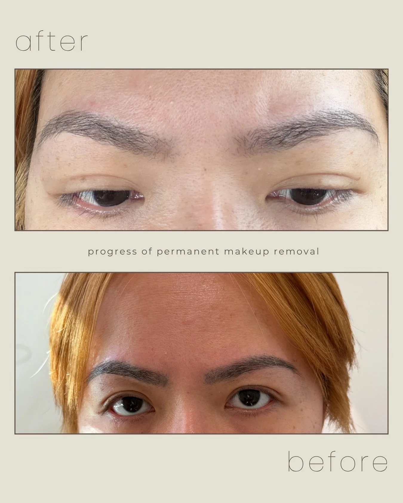 This is your sign that you don&rsquo;t have to live with permanent makeup you no longer love. Removal is a process, but progress like this makes it so worth it.

&bull; Lightens unwanted pigment
&bull; Restores a more natural brow look
&bull; Creates