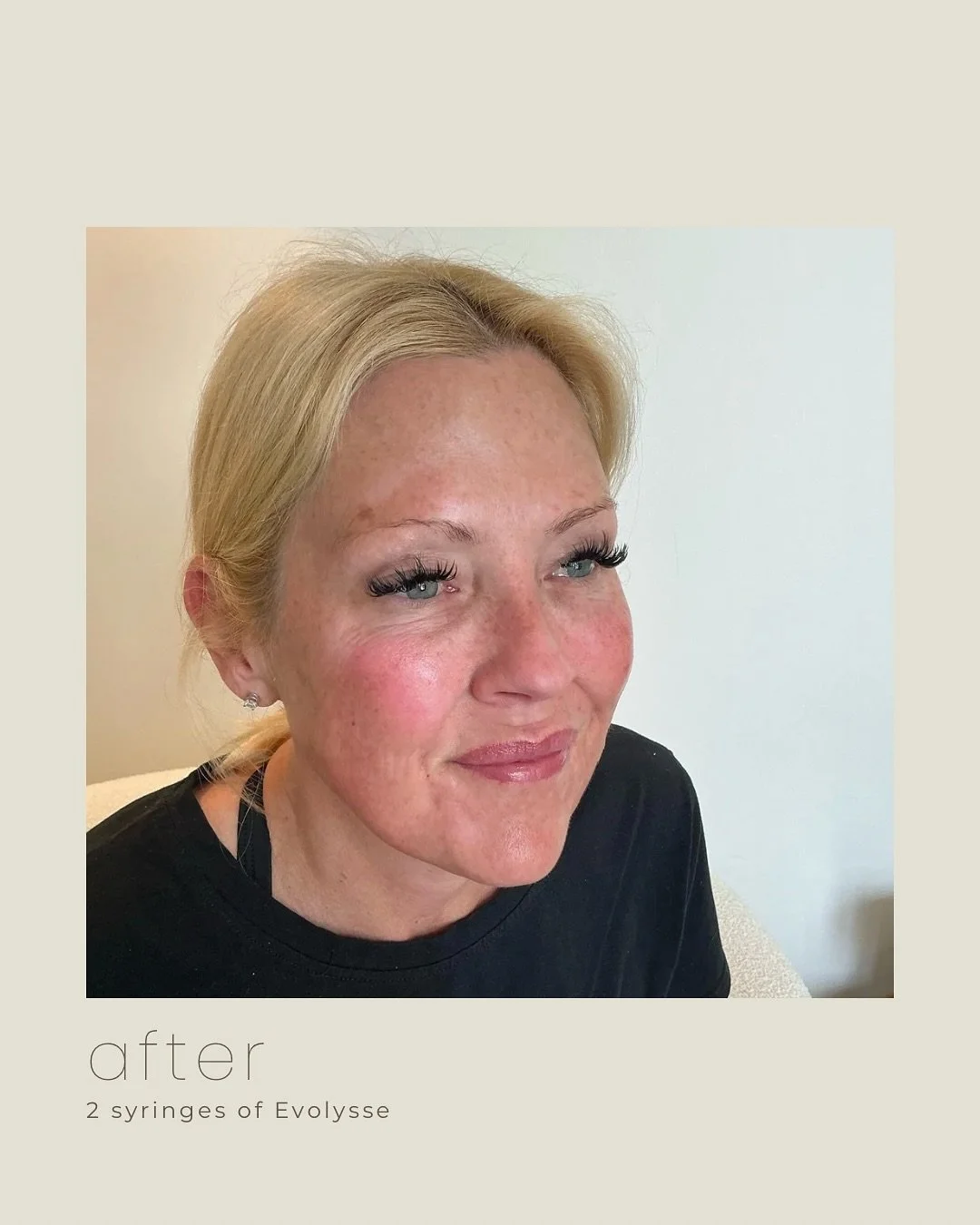 Subtle volume restoration can make such a difference 🤍

2 syringes of Evolysse strategically placed to soften deeper lines, restore support, and create a smoother, more refreshed look without looking overdone.

Swipe to see the before, after, and tr