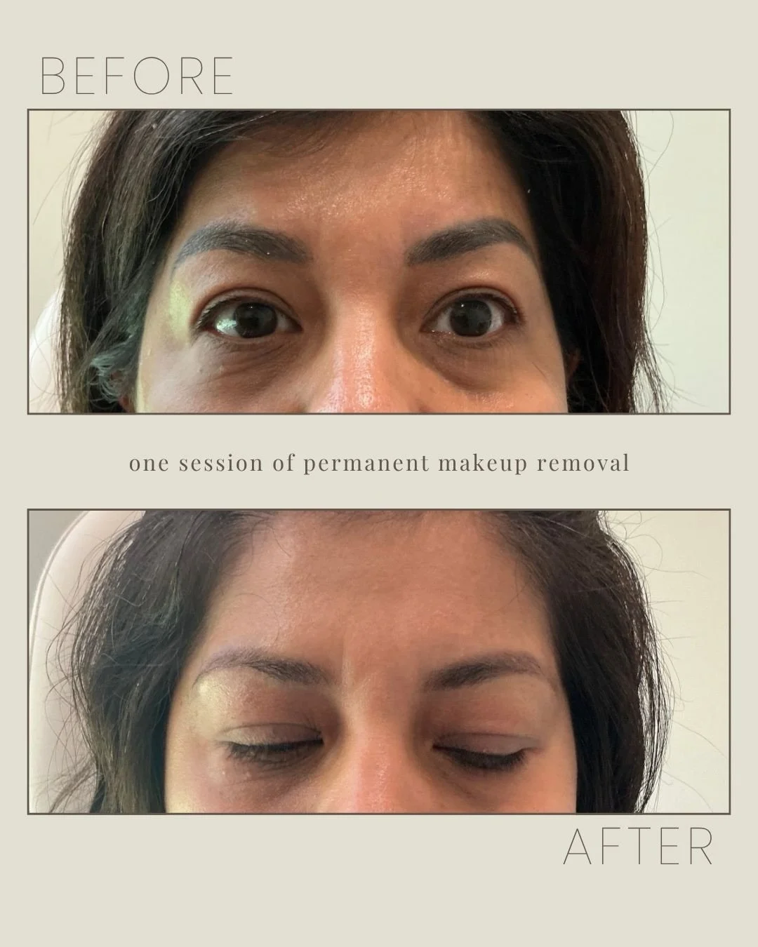 Your sign that your old permanent makeup doesn&rsquo;t have to be permanent. 🤍 Just ONE session!

#lasers #dfwmedspa #permanentmakeupremoval #fortworth