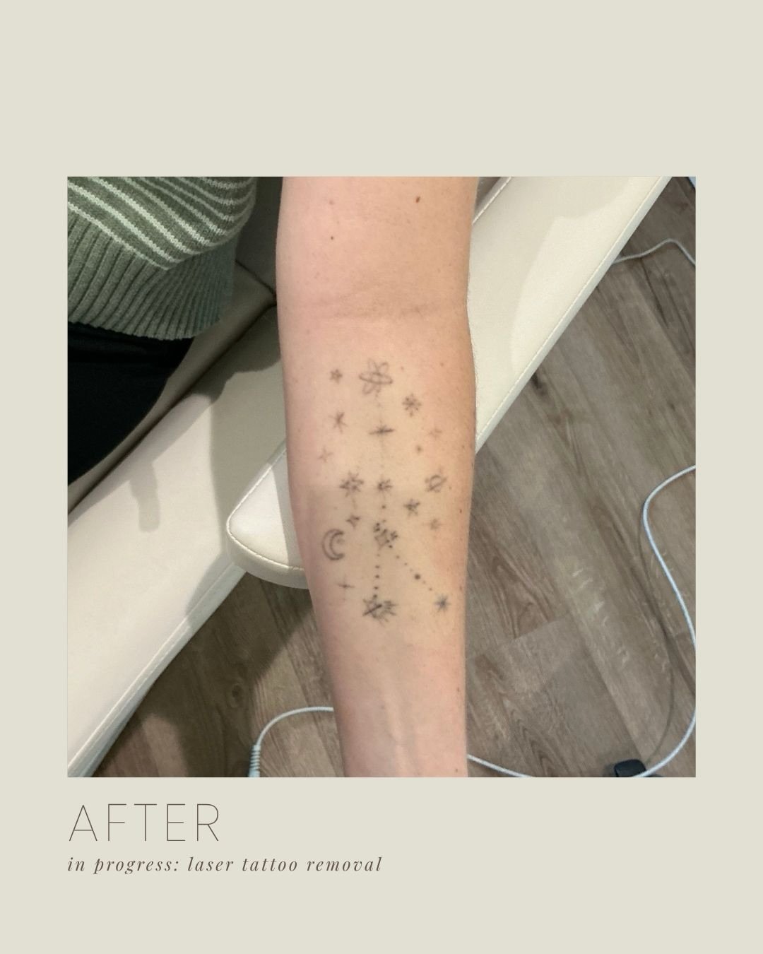 LASER TATTOO REMOVAL PROGRESS 🤍

After just 5 sessions, and we can&rsquo;t wait to see the final results!

#tattooremoval #lasertreatments #laserdfw #fortworth