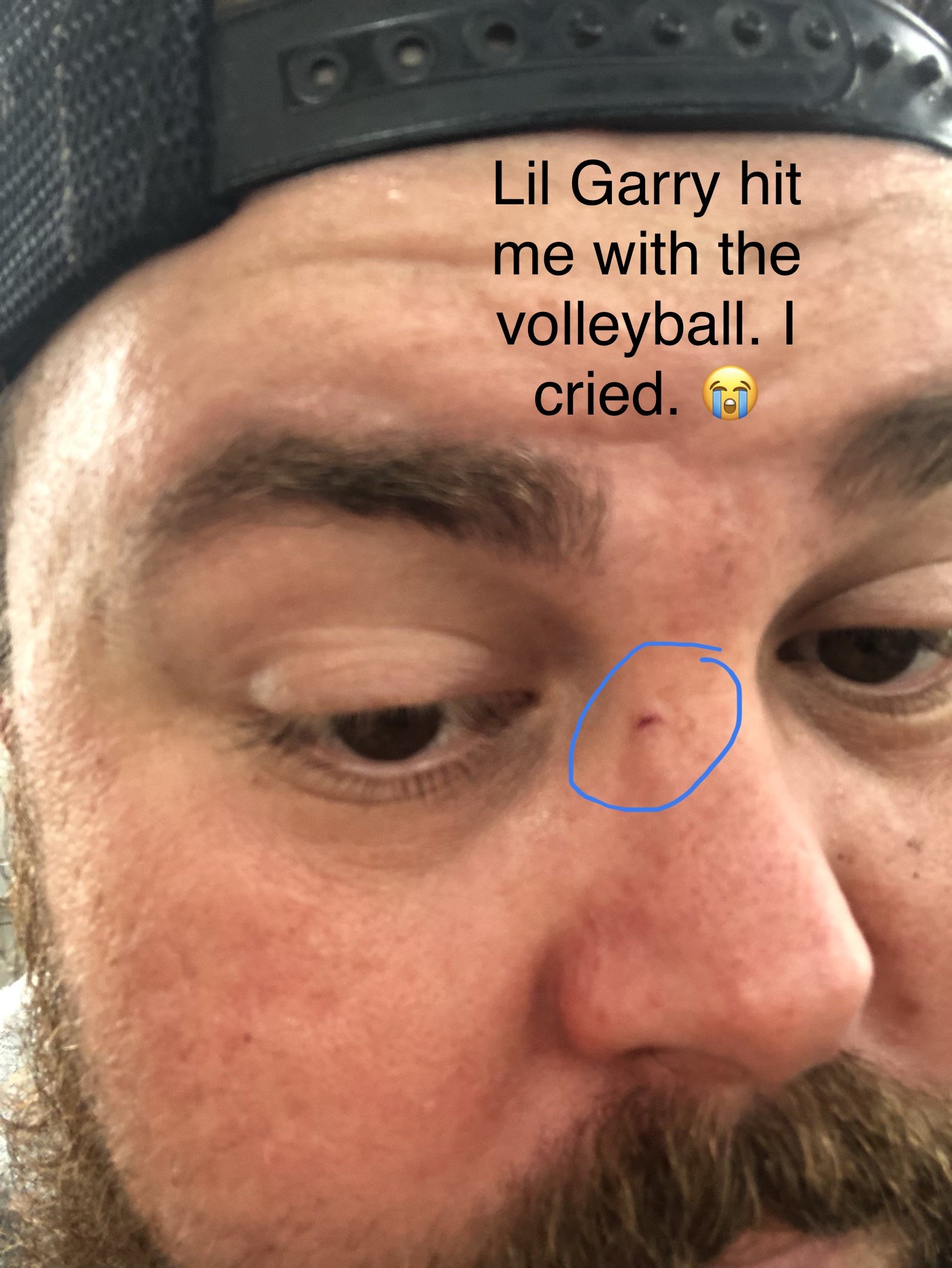 Close-up of a person's face with a bruise or mark near the nose, highlighted by a blue circle. Text reads: 'Lil Garry hit me with the volleyball. I cried.' with a crying emoji. The person is wearing a dark-colored cap.
