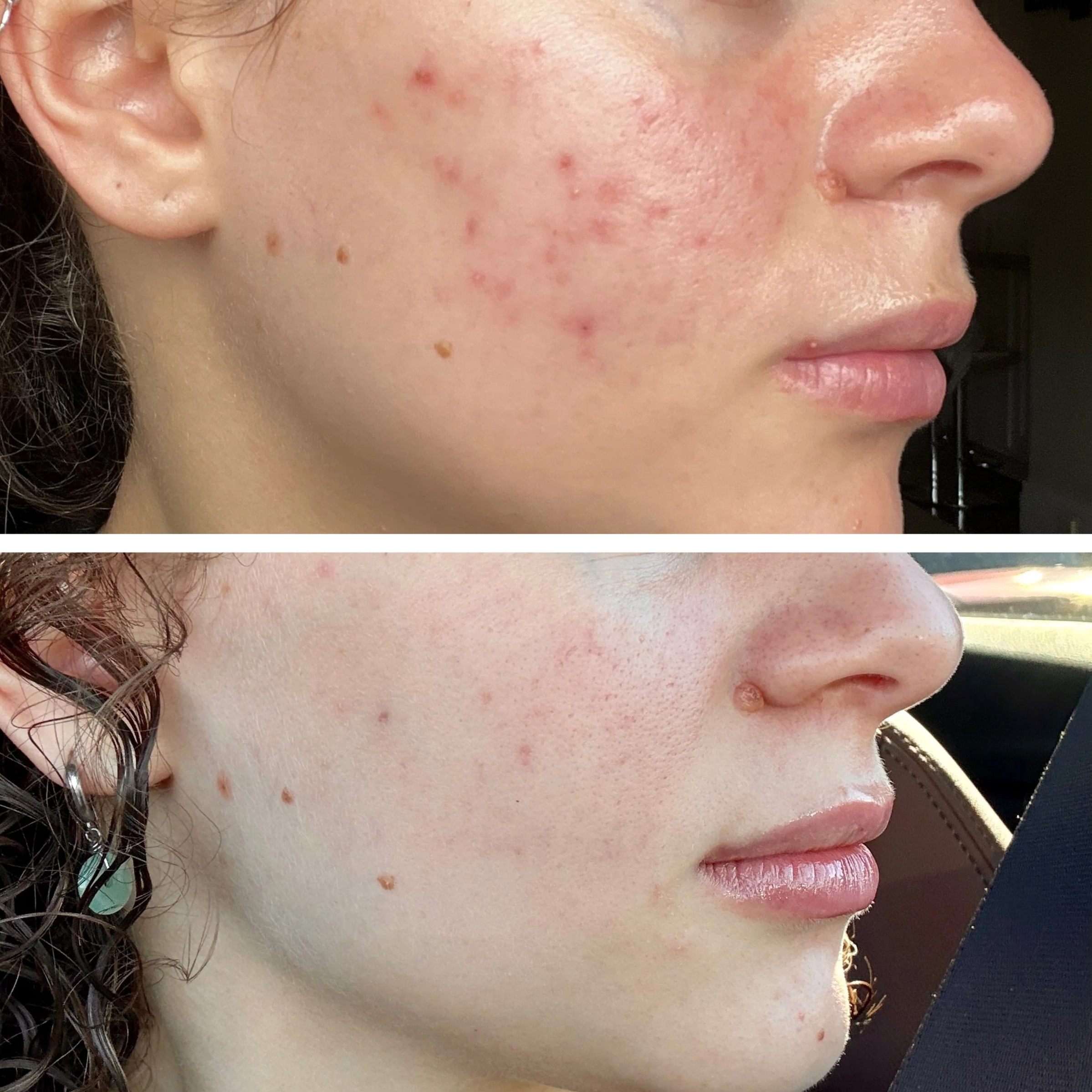 Comparison of skin condition on person's cheek before and after acne treatment, showing reduction in redness and blemishes.