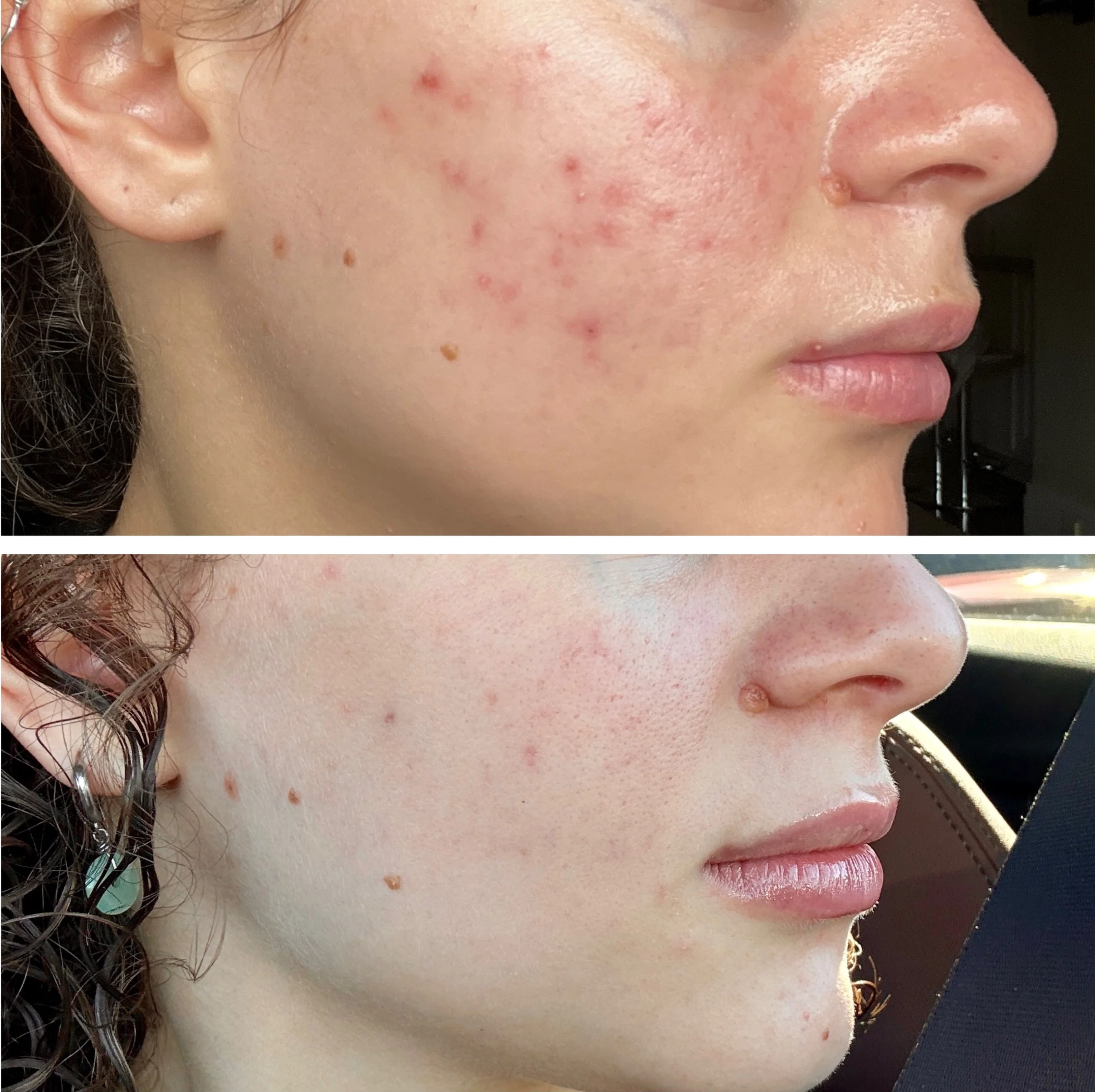 Before and after images showing a significant improvement in skin acne and redness on a woman's face.