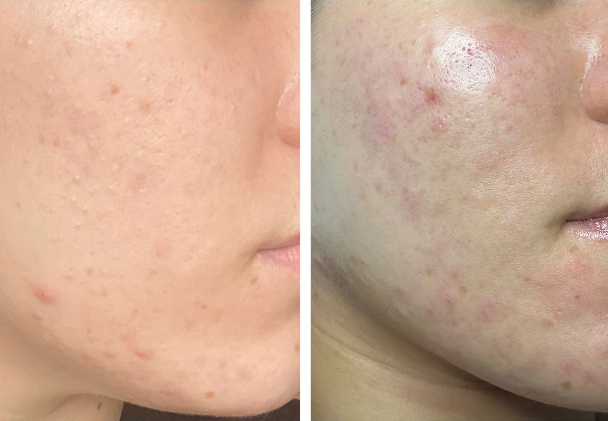 Close-up of a person's cheek showing before and after images of skin with acne, redness, and pigmentation.