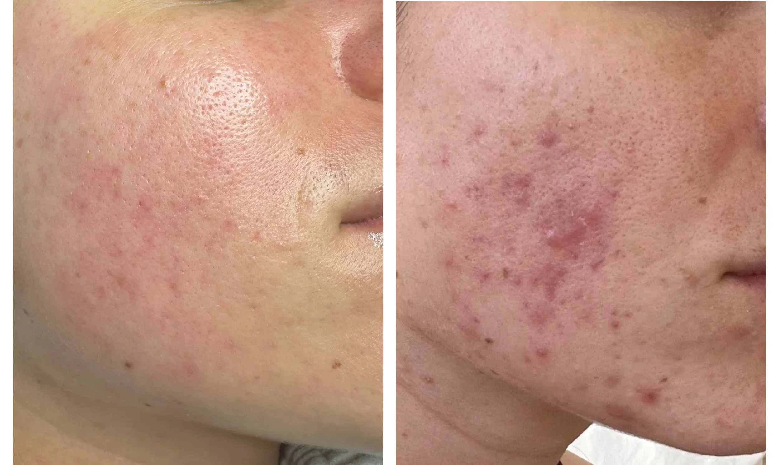 Close-up of a person's cheek showing before and after skin treatment, with visible reduction in acne scars and redness.