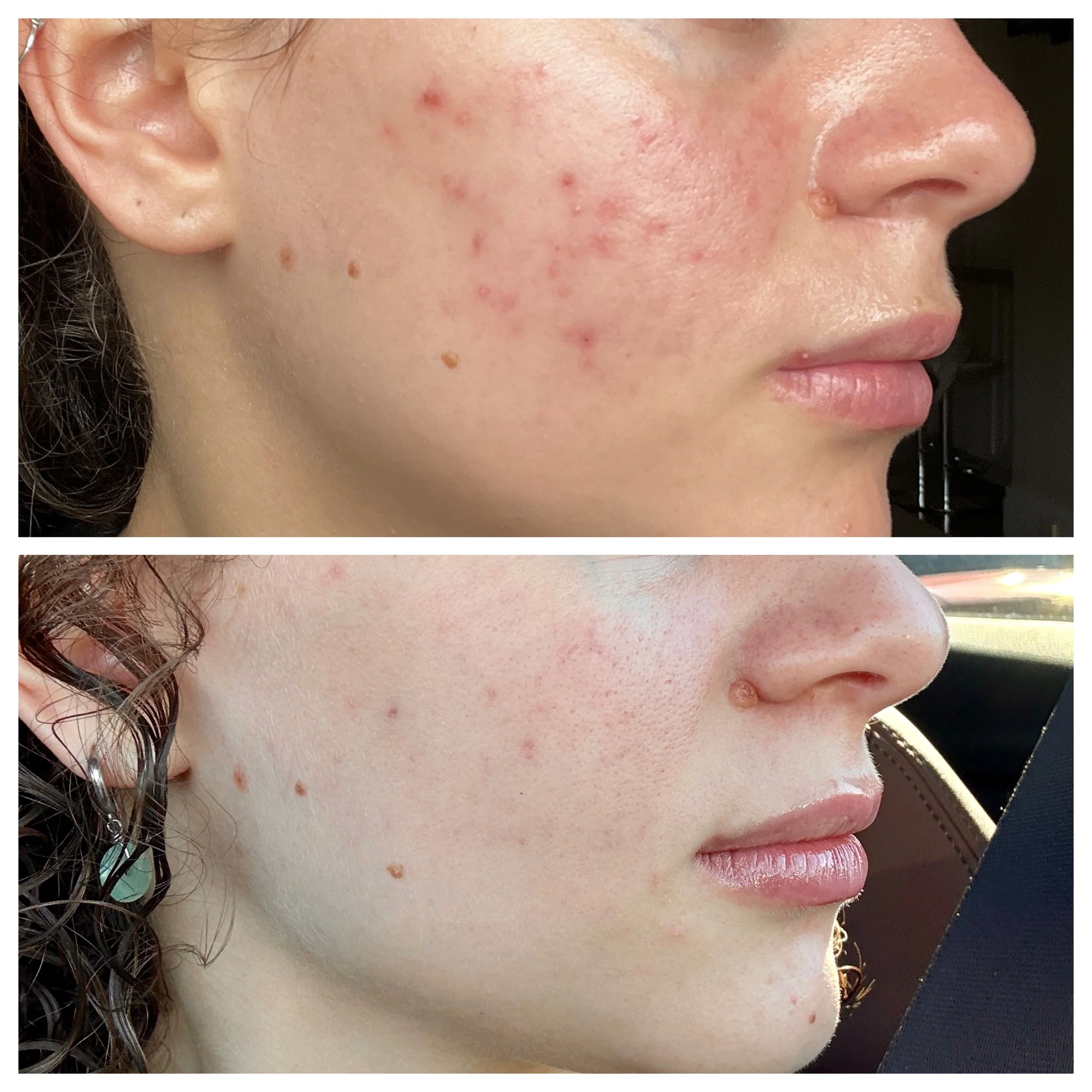 Before and after - acne skin that has been treated and clear. Side profile of a caucasian woman