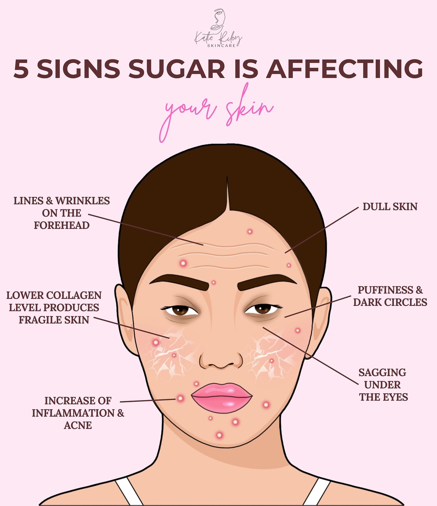 This may be your sign to skip the sweet treat 🍭

An increase in sugar can negatively impact your skin because it:
🍬 Spikes inflammation = red, angry breakouts
🍬 Boosts oil + hormone imbalance = more acne
🍬 Feeds acne-causing bacteria
🍬 Slows hea