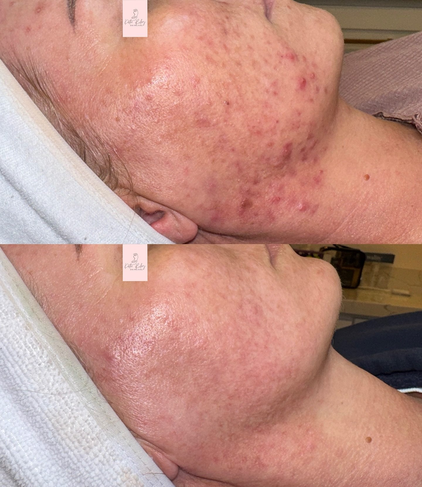 This incredible before &amp; after is the result of consistent home care + frequent in-clinic treatments &mdash; the ultimate duo for real, lasting change 🌟

Clear skin doesn&rsquo;t happen overnight, but with the right guidance &amp; commitment, it