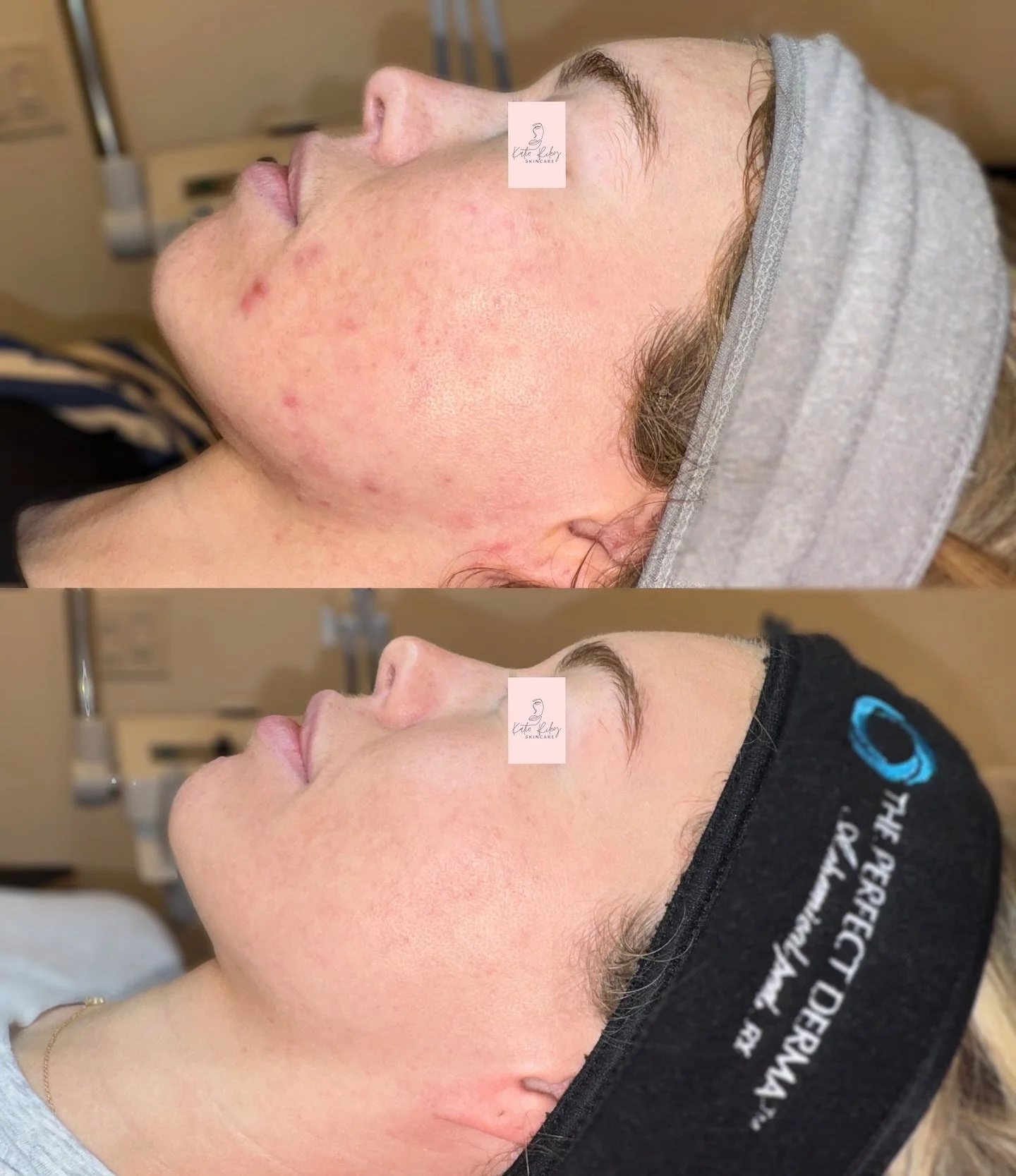 Healthy, radiant skin starts with trust, time, and the right guidance 🤩

These results were achieved through a professional acne treatment plan and fully acne-safe skincare designed for long-term clarity and confidence 🩵

Your skin deserves this ki