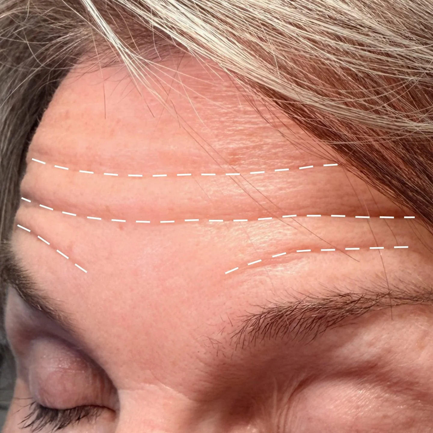 Strategic mapping is the key to natural looking results! ✨

By identifying the dynamic lines on each client, I&rsquo;m able to customize an injection plan for balanced, refined results. Book your appointment through the link in my bio 💕 

#katierile