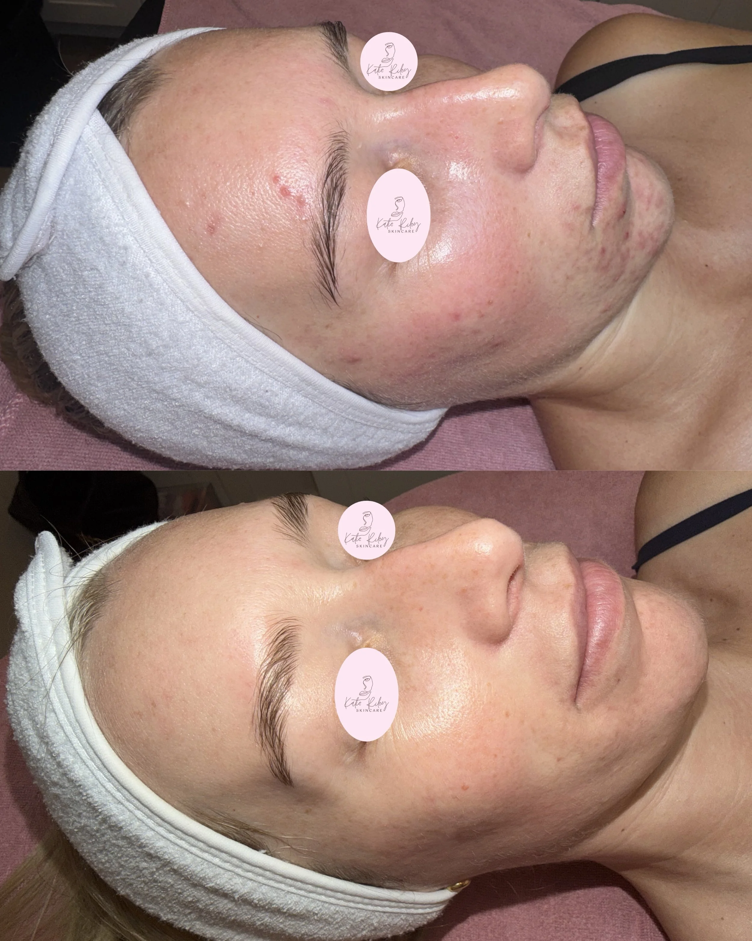 A wedding glow starts months before the big day ✨

Clearer skin, smoother texture, and healthy radiance don&rsquo;t happen overnight &mdash; consistency is everything. Watching this transformation come together has been the best part 🤍

Your makeup 
