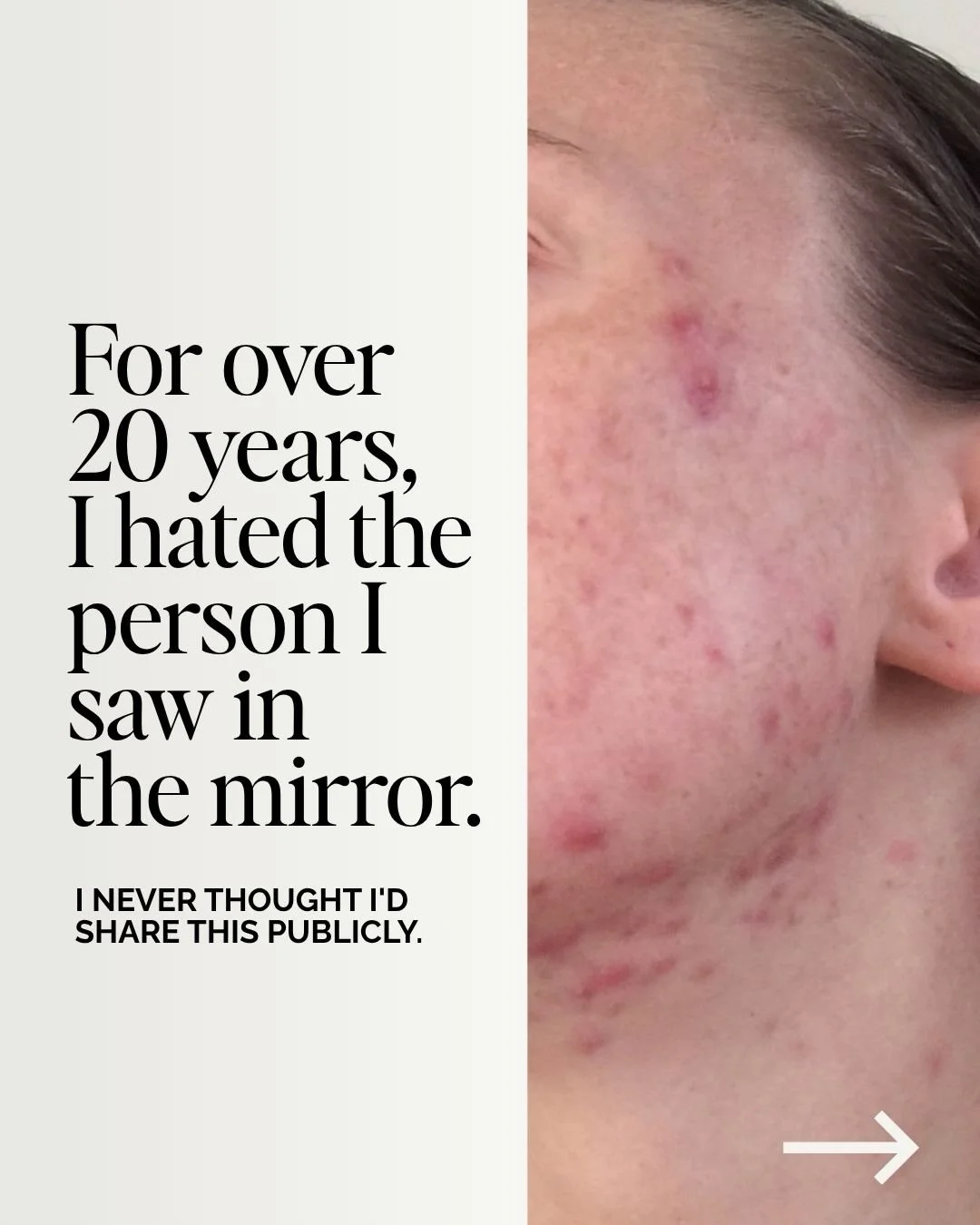 There&rsquo;s something I&rsquo;ve never shared on here&hellip;

I spent nearly 20 years hating who I saw in the mirror. Here is my skin story. 🤍

My periods started at nine. Severe cystic acne followed at eleven, and it took over everything. I crie