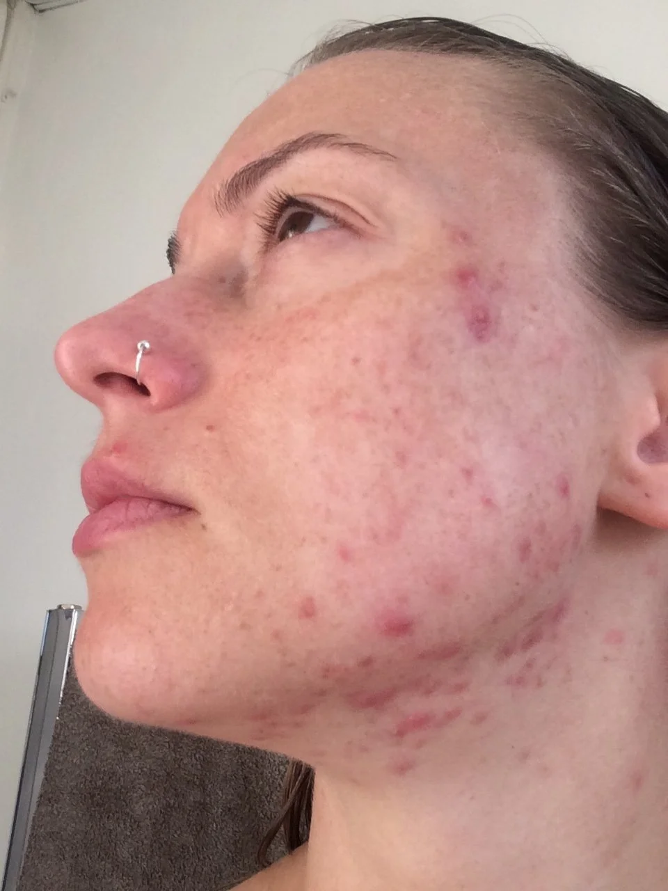 michelle age 32 with cystic acne
