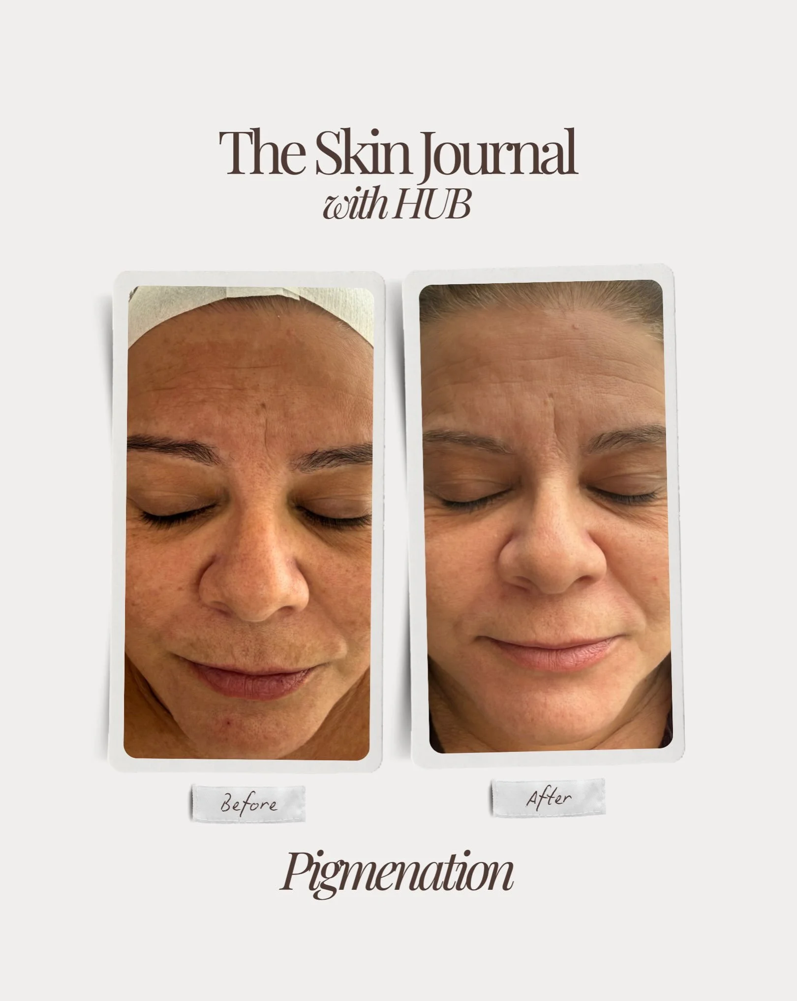 Real skin, real progress ✨

Pigmentation is never one size fits all. The key is understanding the type of pigmentation you&rsquo;re treating, what is driving it, and the best way to suppress its formation while supporting healthy, resilient skin.

Th