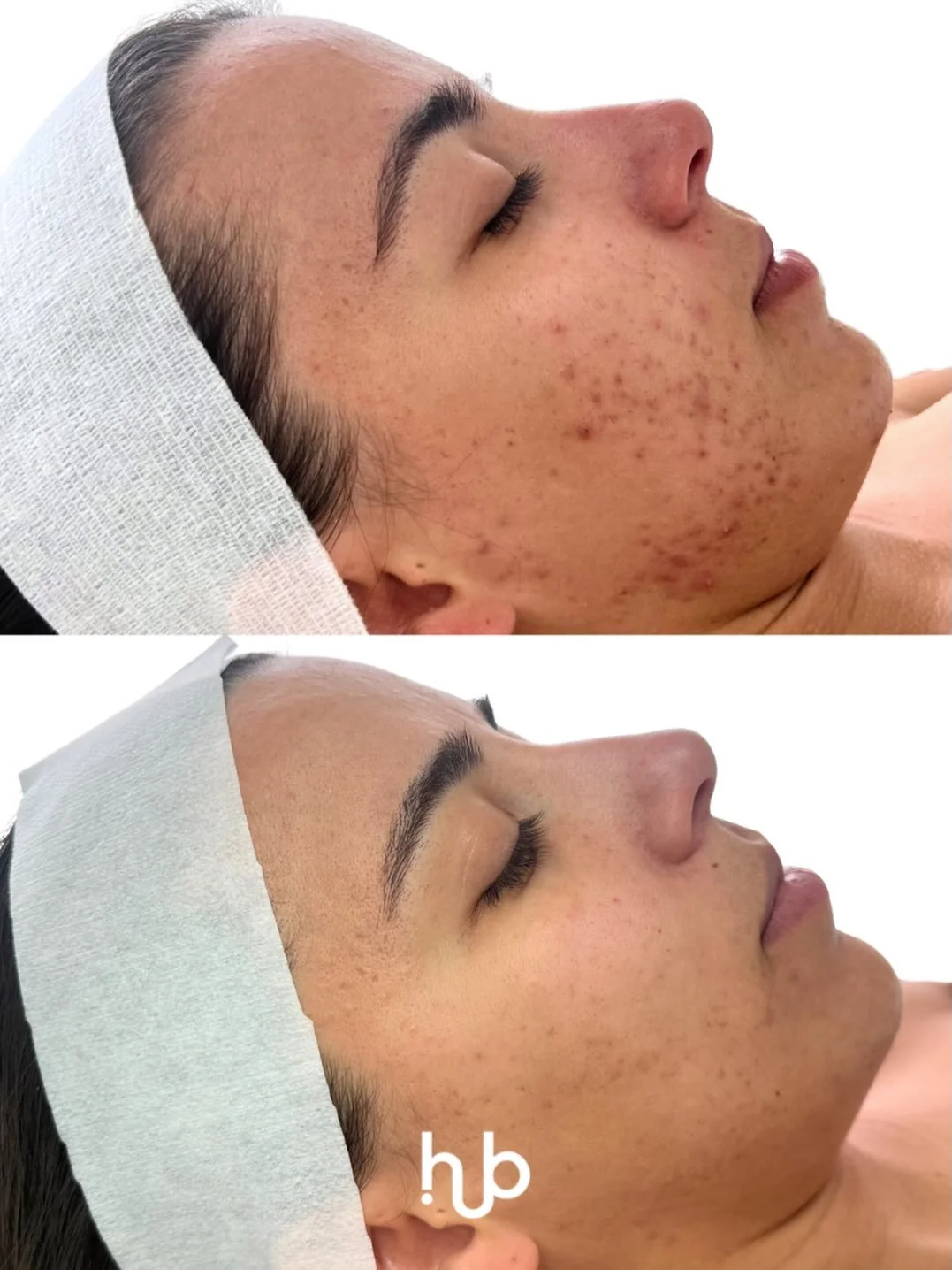 A significant improvement in post-inflammatory erythema (PIE) which is those lingering red marks left behind after breakouts.

You can see a noticeable reduction in redness, a more even skin tone and an overall calmer, clearer complexion.

PIE is one