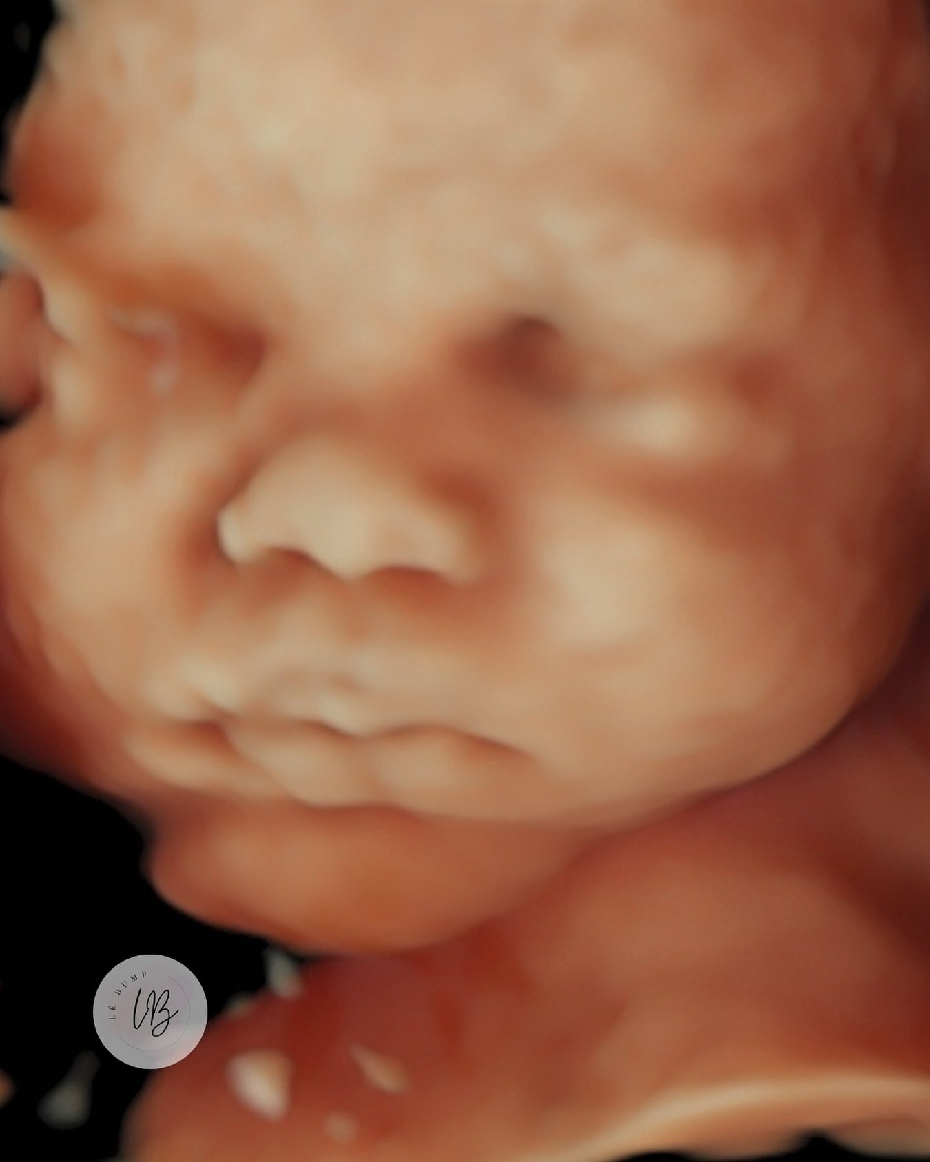 Discover the incredible experience of 3D/4D ultrasound imaging in Haverstraw, NY, at L&eacute; Bump 3D Ultrasound Studio. Our advanced technology allows you to see your baby&rsquo;s detailed facial features, thumb-sucking, and even smiles, offering a