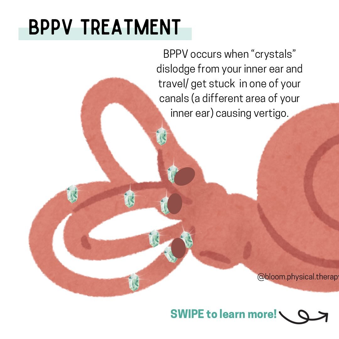 BPPV (benign paroxysmal positional vertigo) occurs when &ldquo;crystals&rdquo; (also known as otoconia) dislodge from an area in your inner ear and travel/ get stuck in another area of your inner ear- the canals.

BPPV is very treatable. The most com