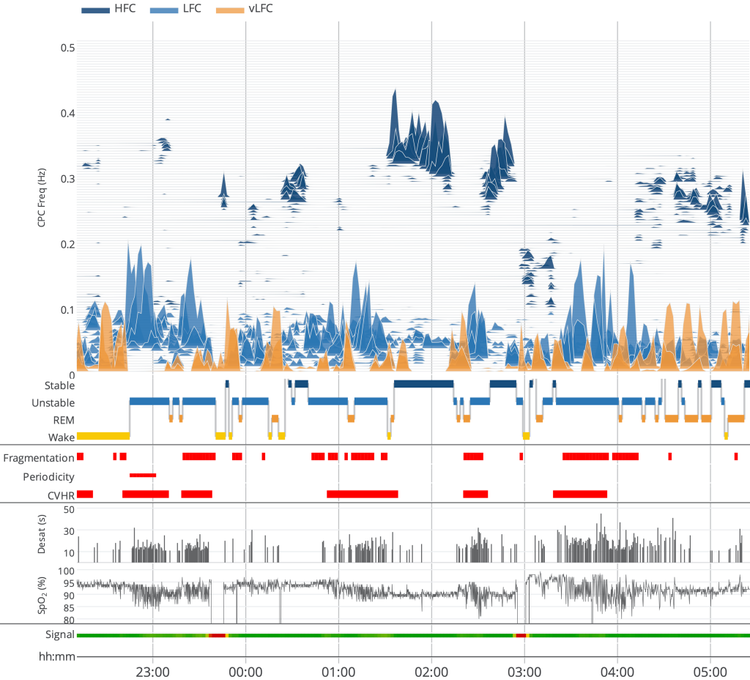 Additional night sleep study