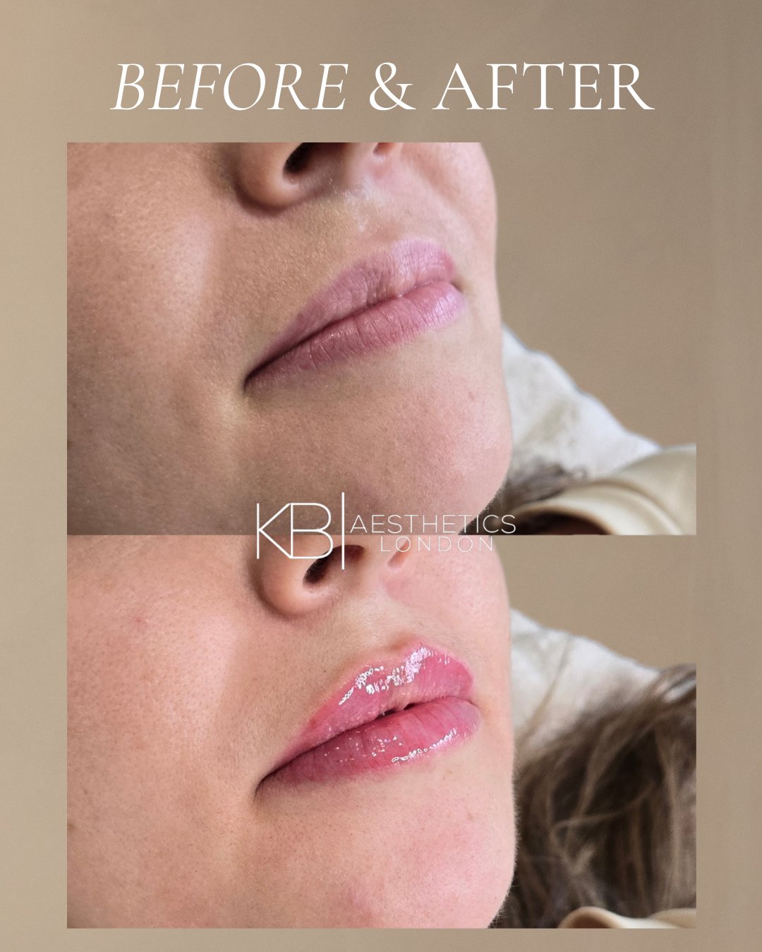 The power of subtle enhancement 💉⁠
⁠
Dermal filler isn&rsquo;t about changing your face - it&rsquo;s about enhancing your natural beauty and restoring the features you already love.⁠
⁠
This client came to us wanting to soften the appearance of volum
