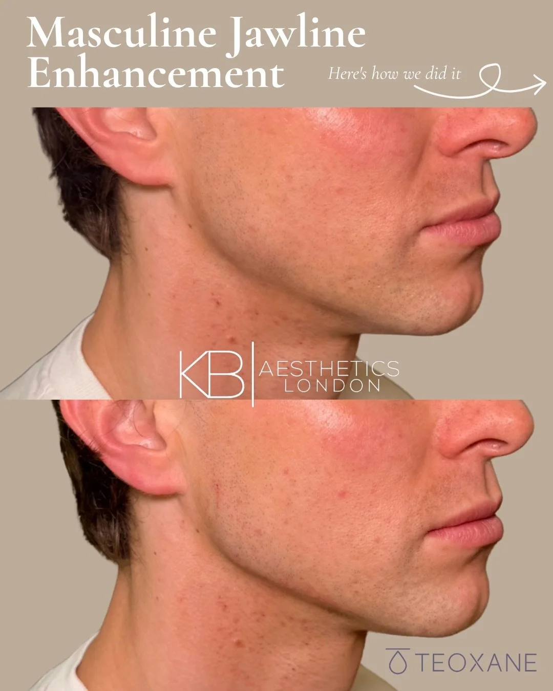 Structured &amp; Sculpted. 📐

This incredible jawline enhancement was achieved using @teoxane_uk dermal filler, creating sharper definition, improved facial balance, and a more contoured profile while maintaining a natural appearance.

The differenc