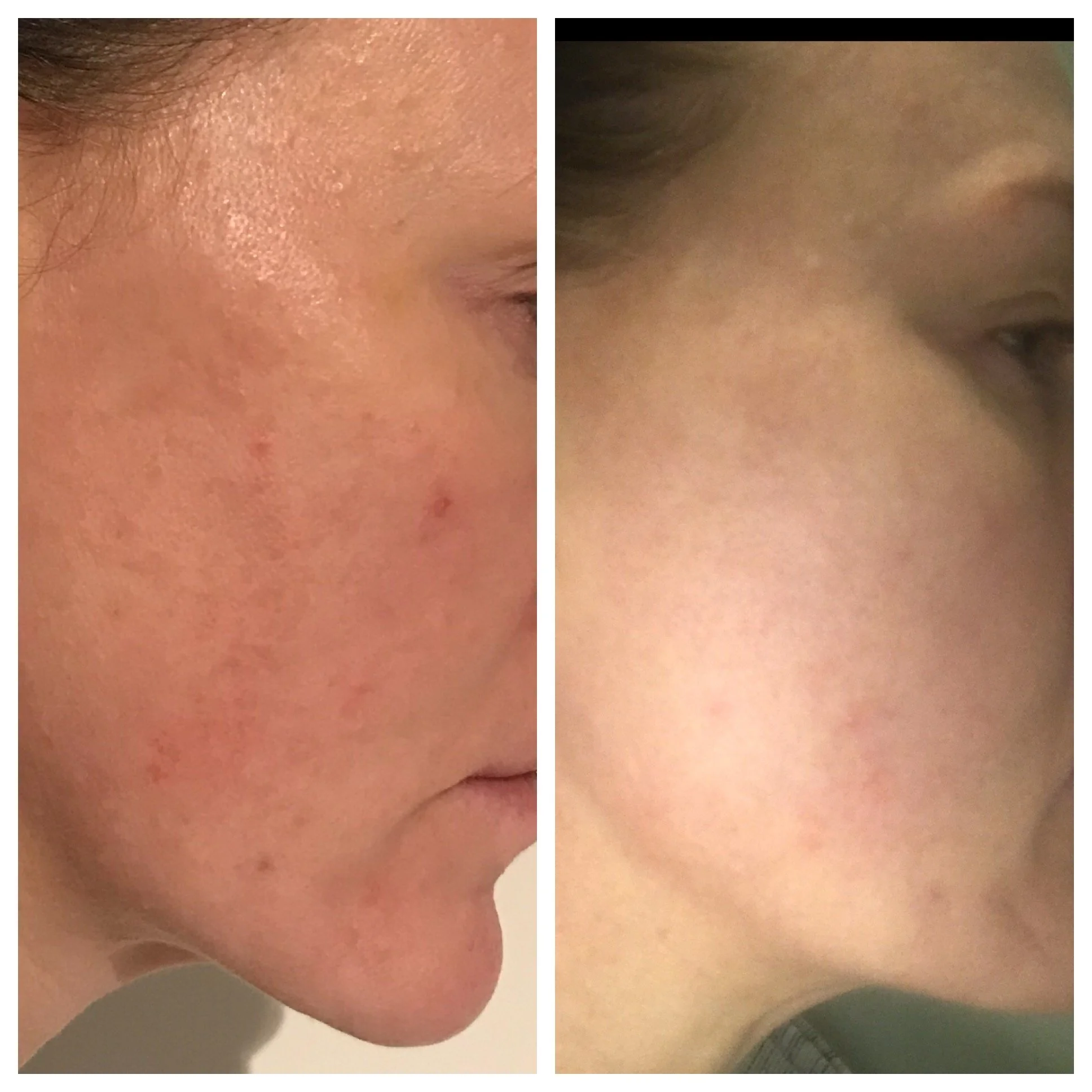 WOW fusion before and after toxing rosacea.JPG