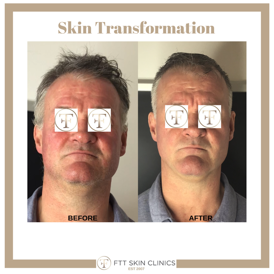 Frances Turner Traill Rosacea model. Credit must be given if using this picture.png