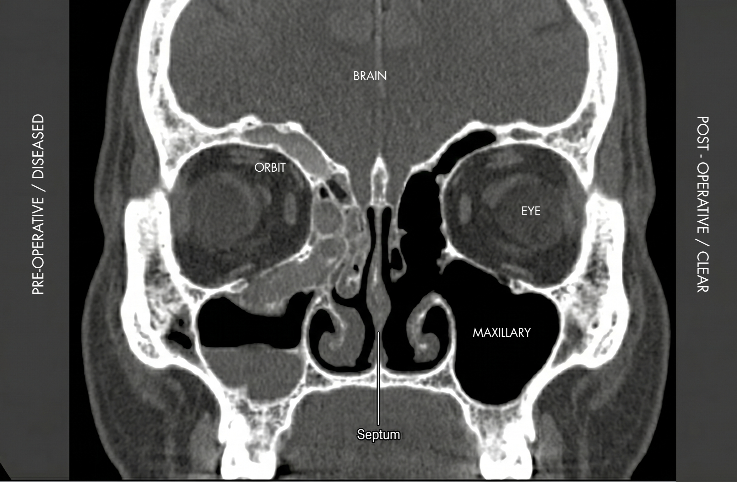 Coronal CT scan of the head showing the brain, orbits, eyes, nasal septum, and maxillary sinuses, with labels for the brain, orbit, eye, septum, and maxillary.