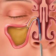 Medical illustration of the Ballon Sinuplasty procedure for runny noses. A procedure that Dr. Yerukhim can perform in the office with excellent results and utmost patient comfort