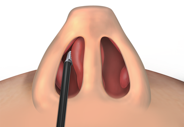 A digital illustration with a close-up view of a human nose showing Vivaer treatment of the septal swell body - A procedure that Dr. Yerukhim can perform in the office with excellent results and utmost patient comfort