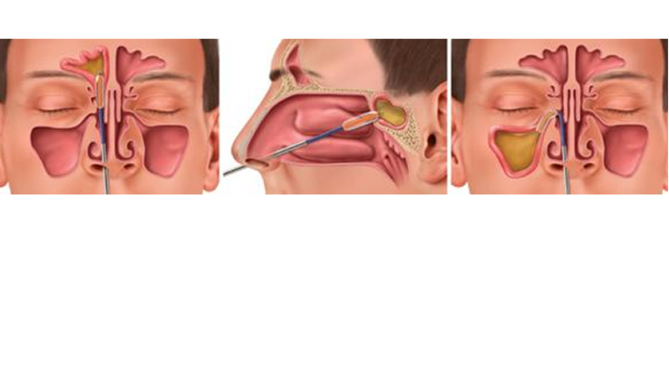 Diagram of Balloon Sinuplasty procedure - a procedure that Dr Yerukhim performs in the office, with excellent results and utmost patient comfort, in Cleveland, Ohio