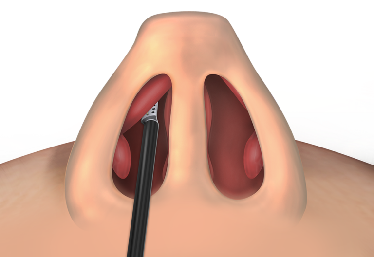 A digital illustration with a close-up view of a human nose showing Vivaer treatment of the nasal valve collapse - A procedure that Dr. Yerukhim can perform in the office with excellent results and utmost patient comfort