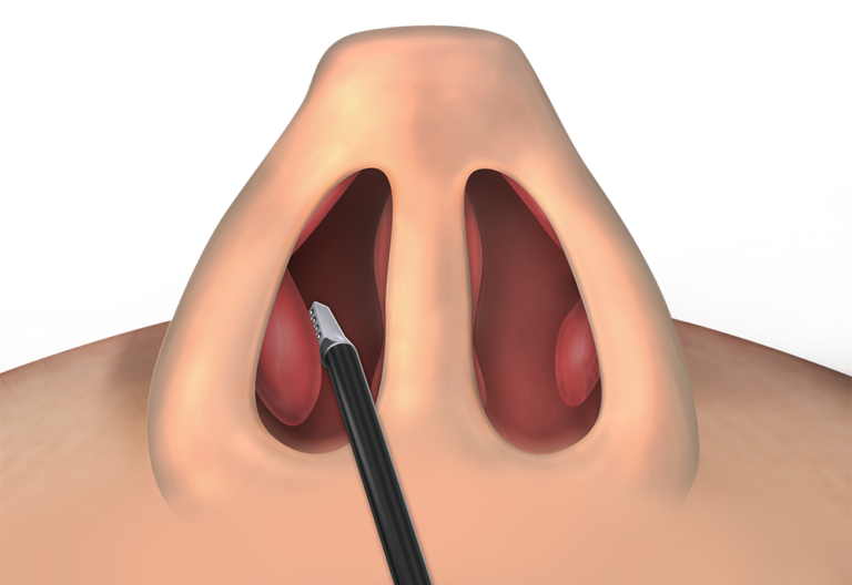 A digital illustration with a close-up view of a human nose showing Vivaer treatment of the inferior turbinate - A procedure that Dr. Yerukhim can perform in the office with excellent results and utmost patient comfort