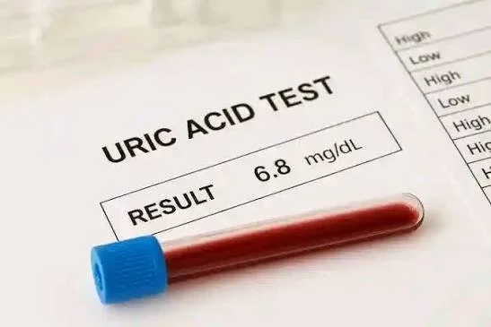 Uric Acid (Gout Test) | Serum