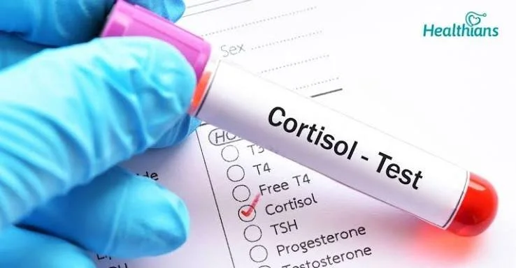 Cortisol AM | Serum