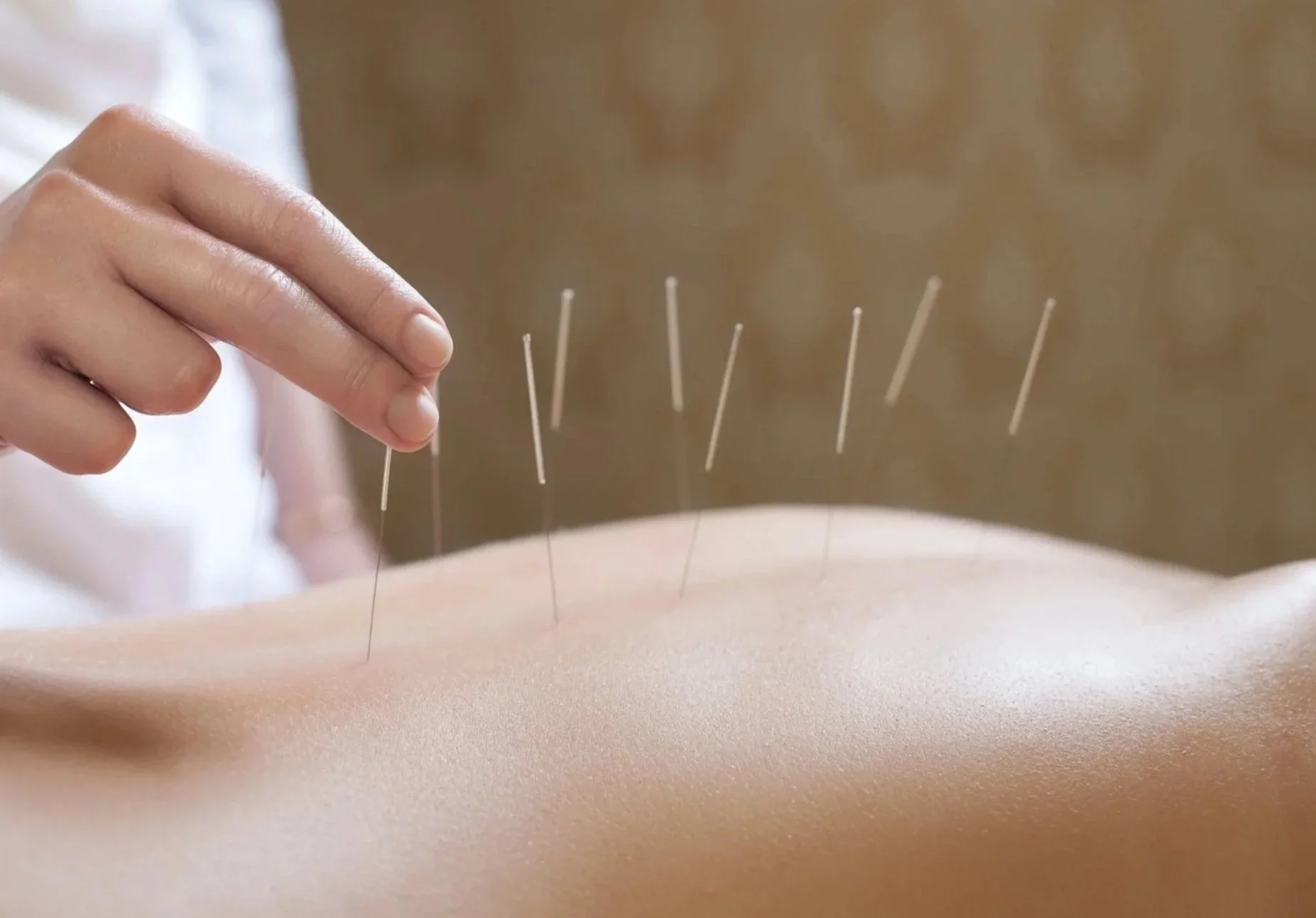 Close-up of a person performing acupuncture on a patient's back using thin needles.