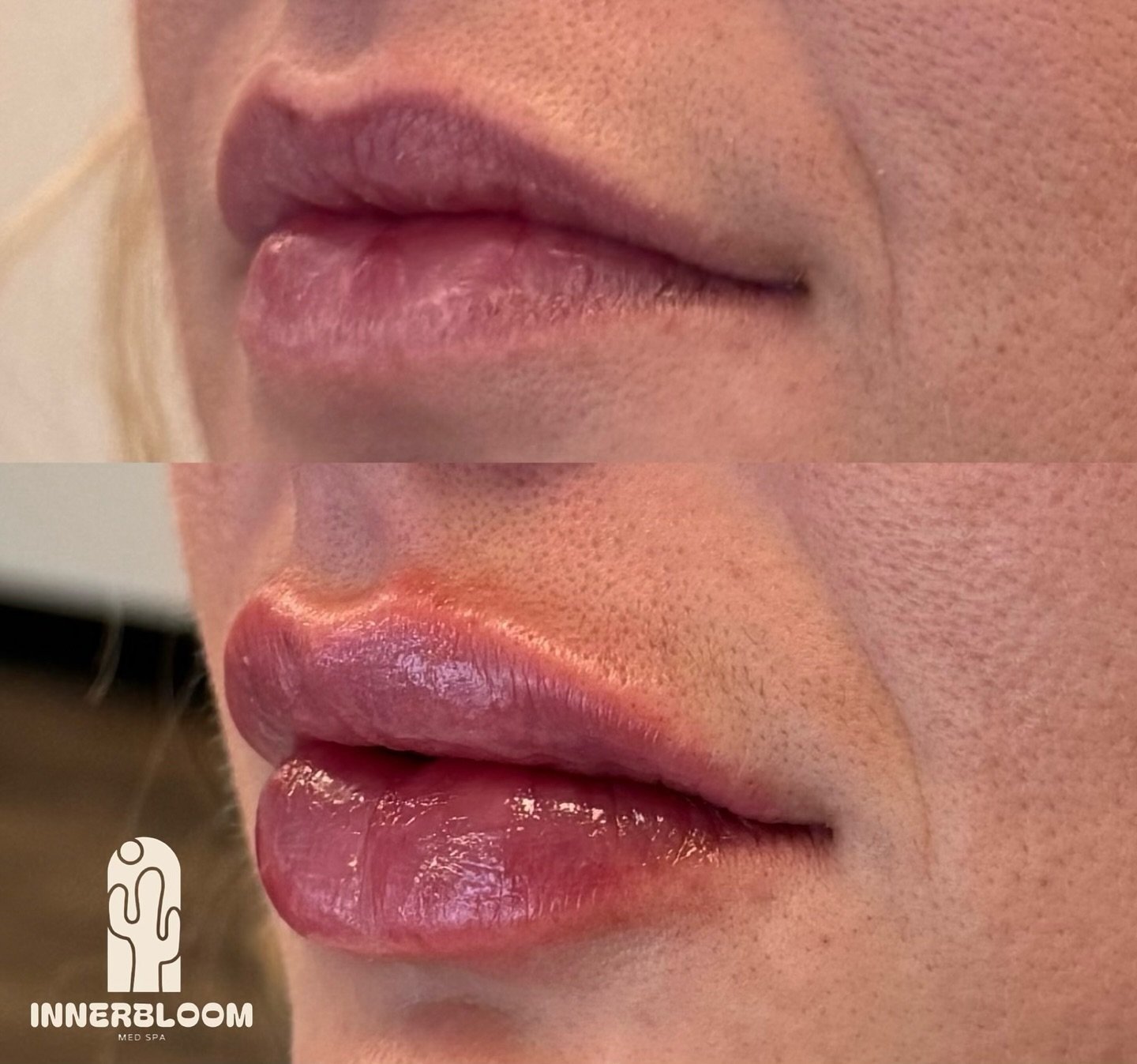Beautiful lips for a beautiful patient 😭 
This patient loved her natural lips but wanted to give them more hydration and fullness. Nothing like getting your lippies before the summer months ☀️
*Swelling is present in the after

#denver #lipfiller #l