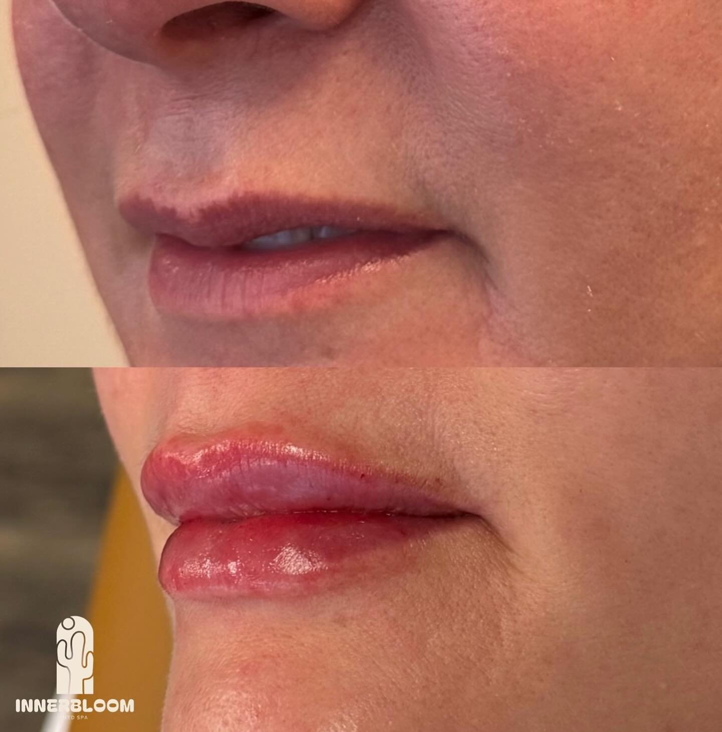 Can&rsquo;t get enough of these lippies 😍 This transformation happened over the course of a month, where the patient received a full syringe of filler split up into 2 appointments.

Product: Revanesse Lips 1.2 mL

NEW PATIENT PROMO: $100 off first f
