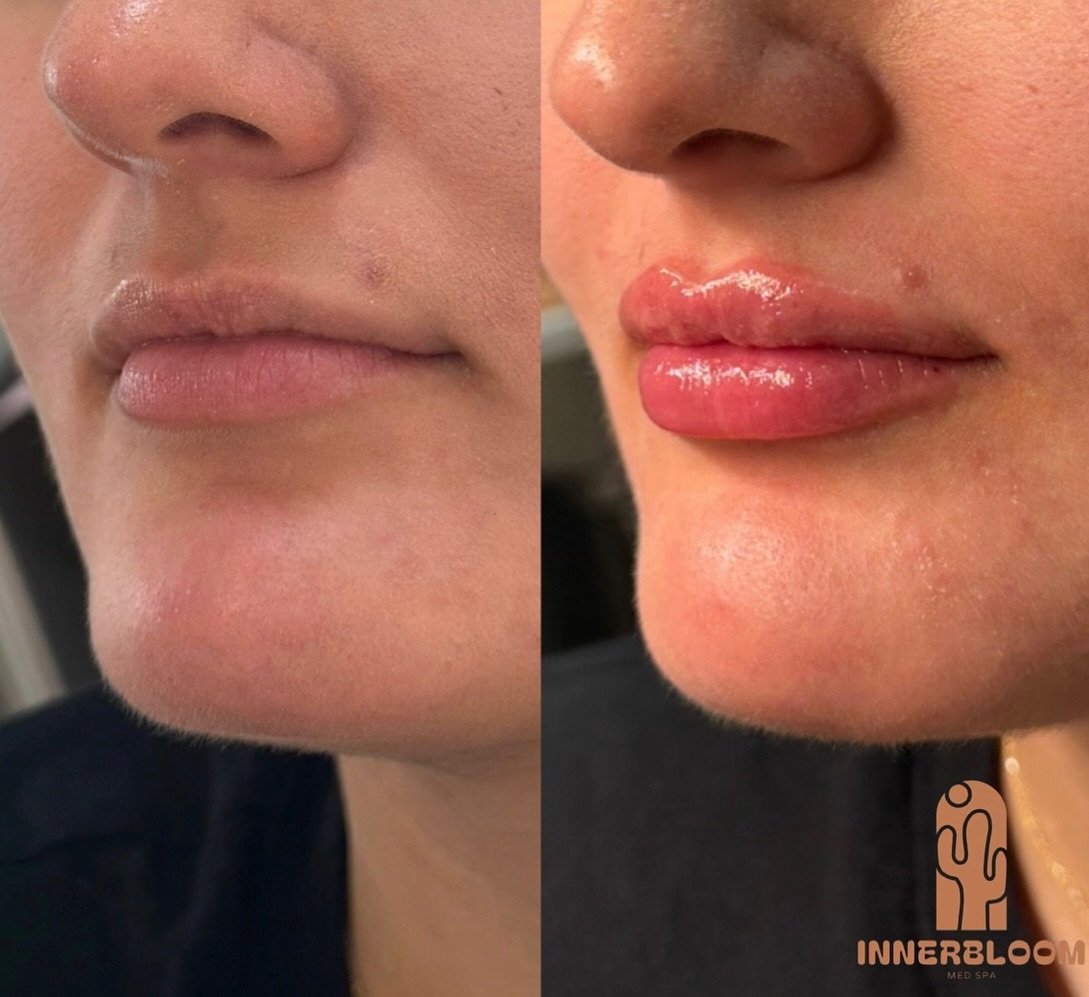 This. Right here, is why I love what I do. 🥹

It&rsquo;s not just about creating fuller lips. It&rsquo;s about restoring confidence, enhancing what&rsquo;s already beautiful, and helping people feel like themselves again. Every face, every story, ev