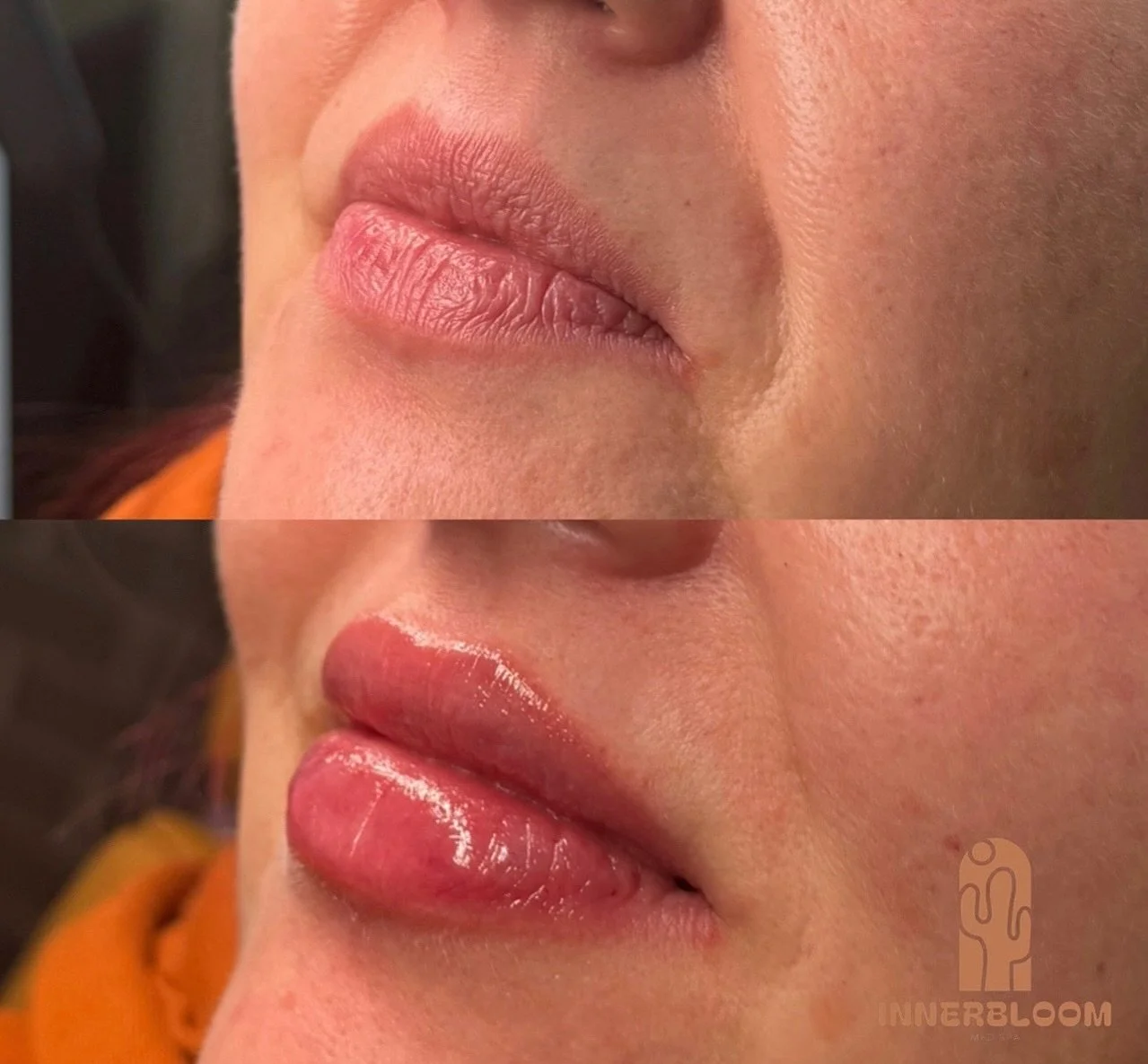 Bodacious, plump, juicy. I cannot get over these lipssssss😙

#restylanekysse #restylanekysse💋 #lipfillers