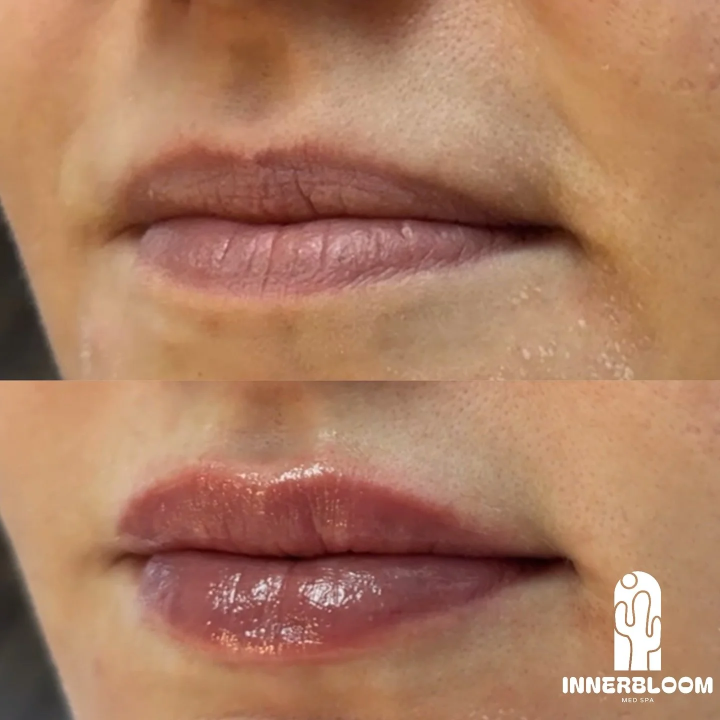 soft volume.
no duck.
full impact.

💉Half syringe of Revanesse 

#revanesse #revanesselipsreveal #revanesselips💋 #littleton #filler